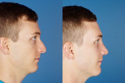 rhinoplasty