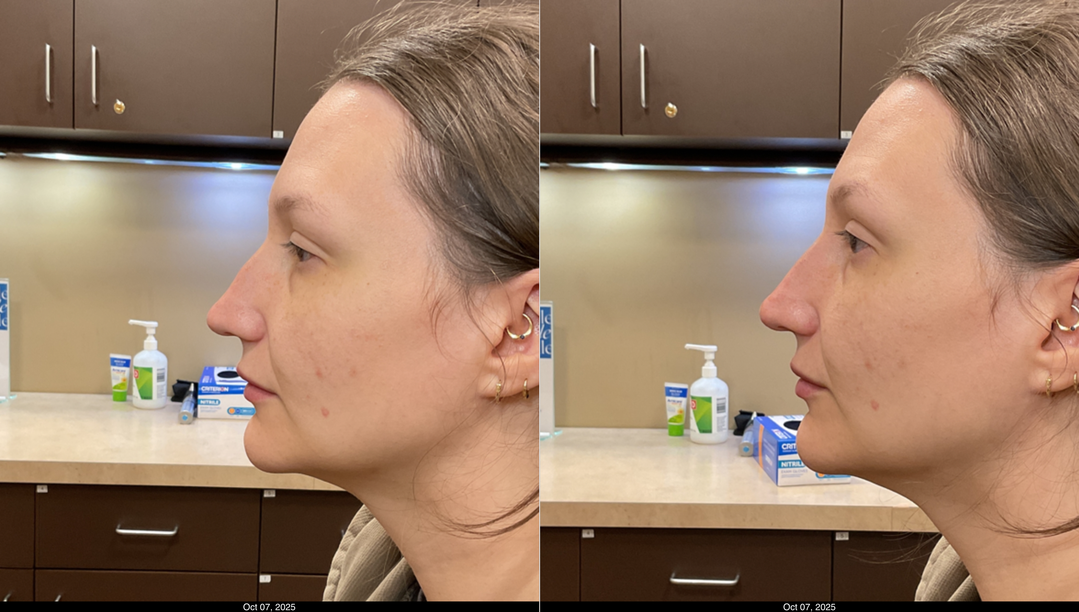 Before and After Nose Filler (5)