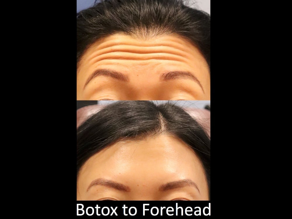 Botox-filler-126- 1 of 1