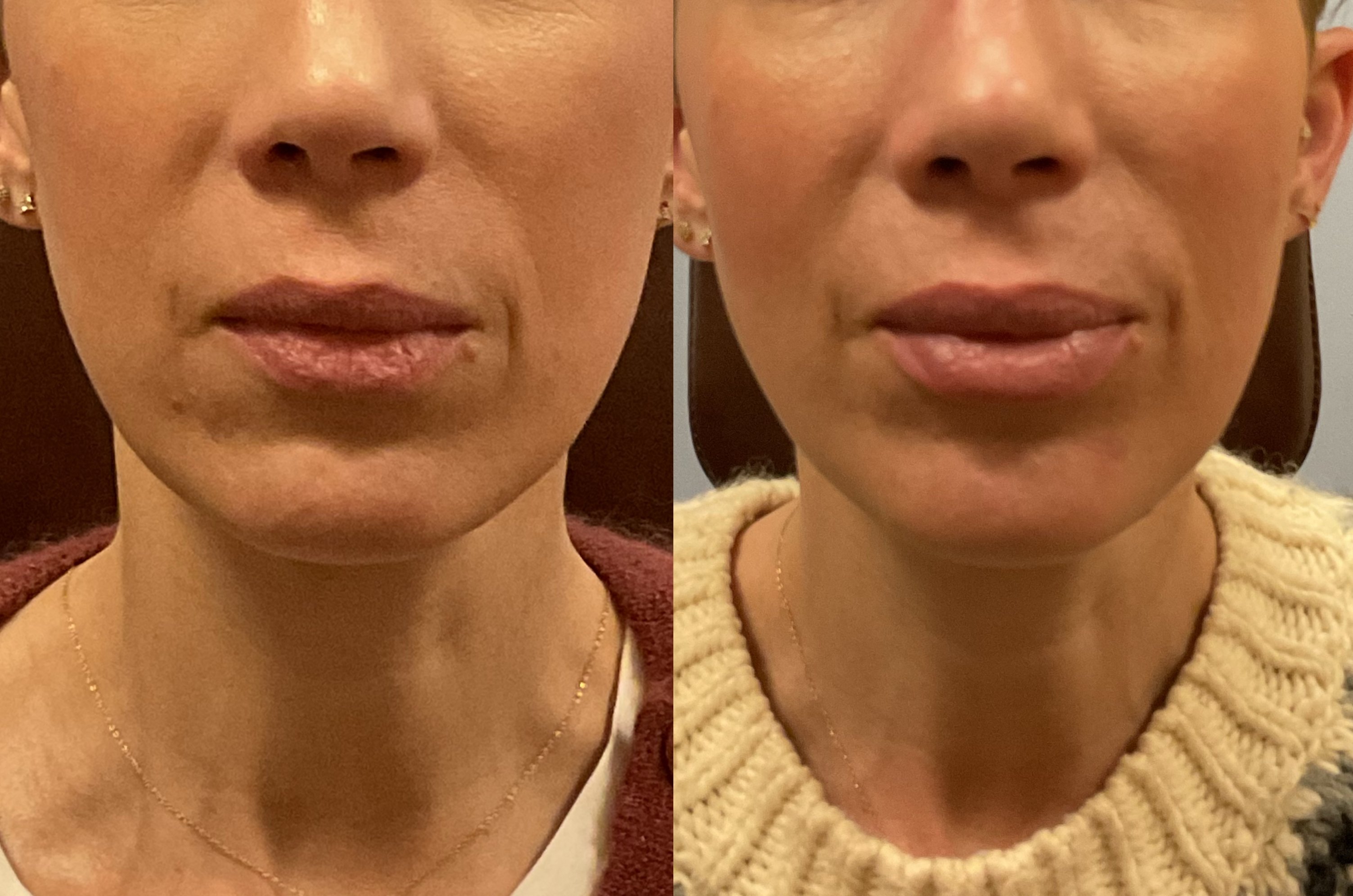 Botox-fillers-144-1 of 3*