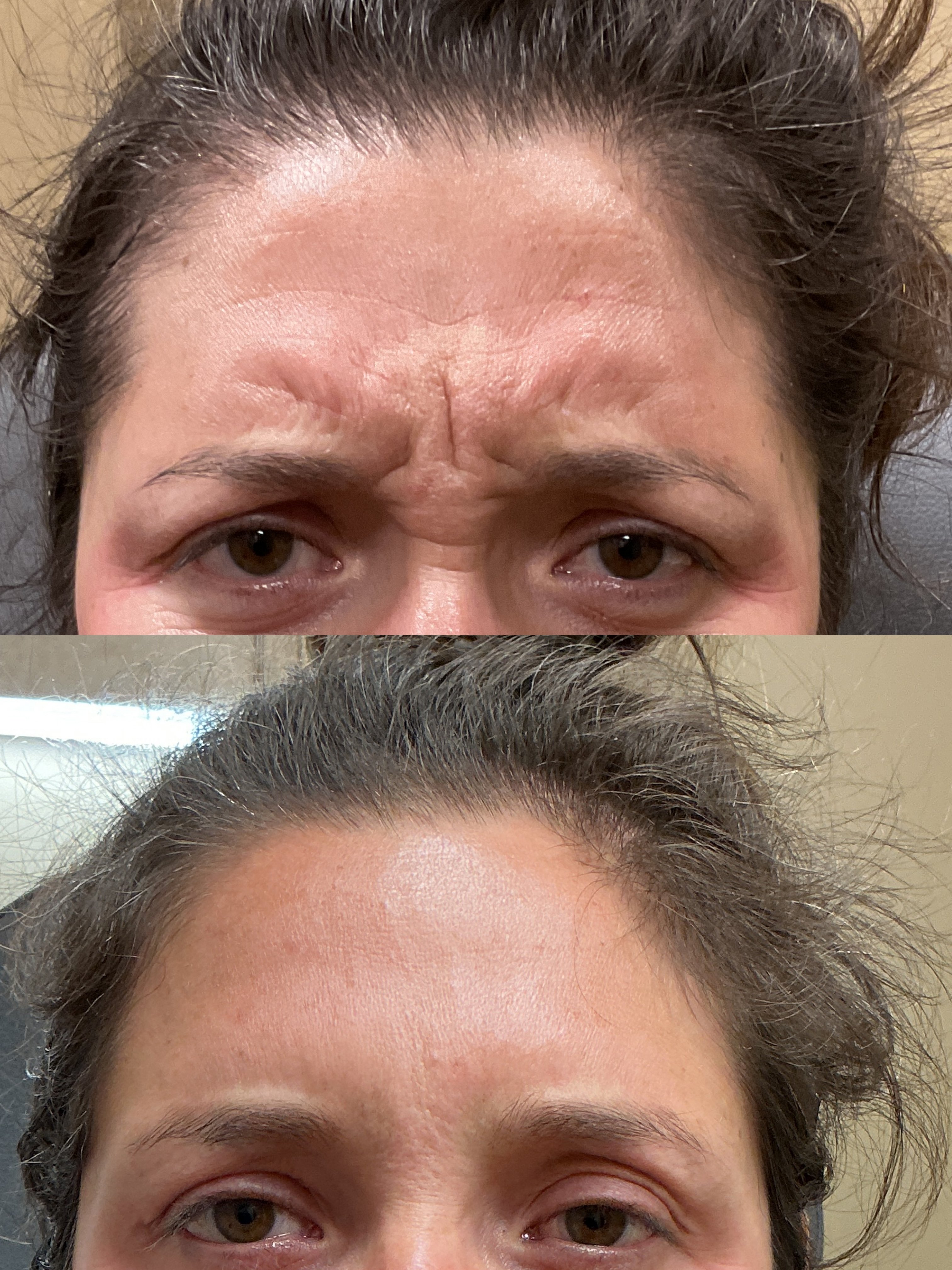 Btx fh and glabella (2)