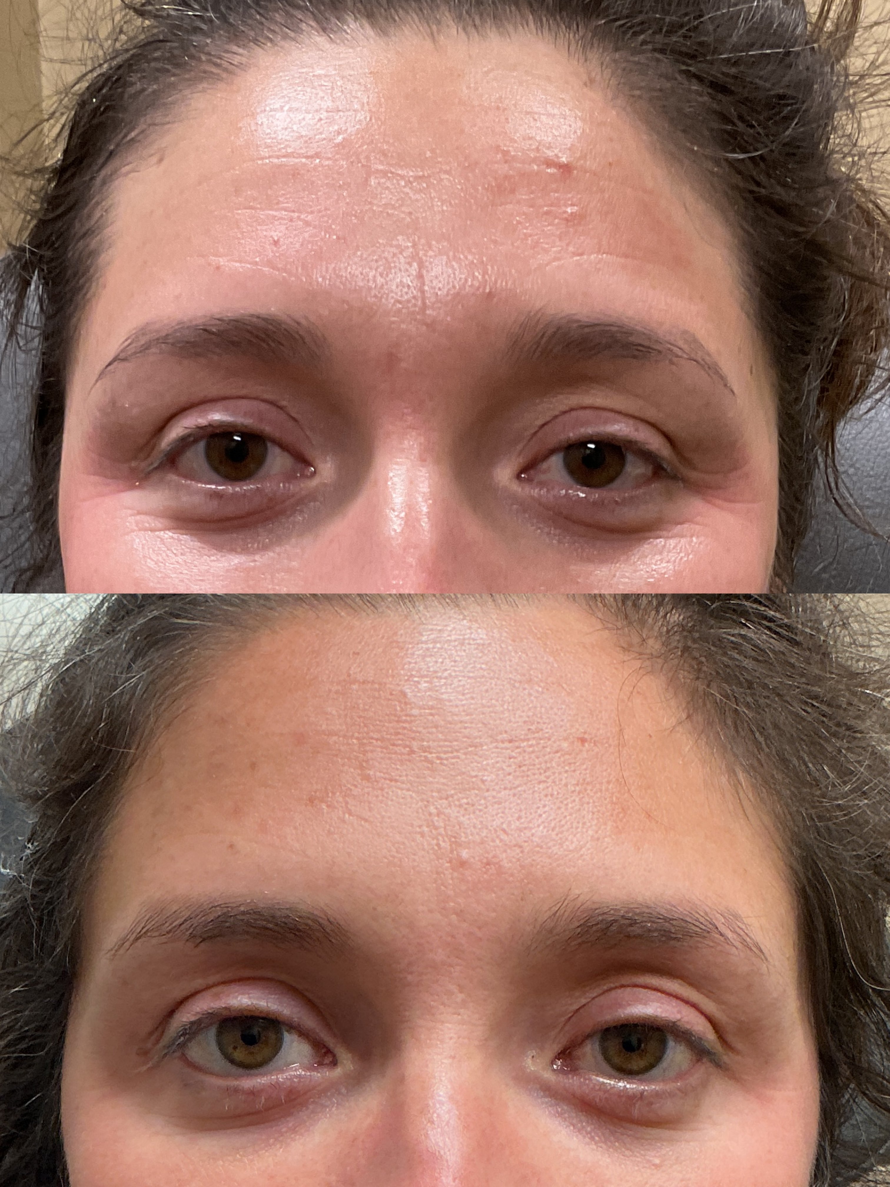 Btx fh and glabella (3)