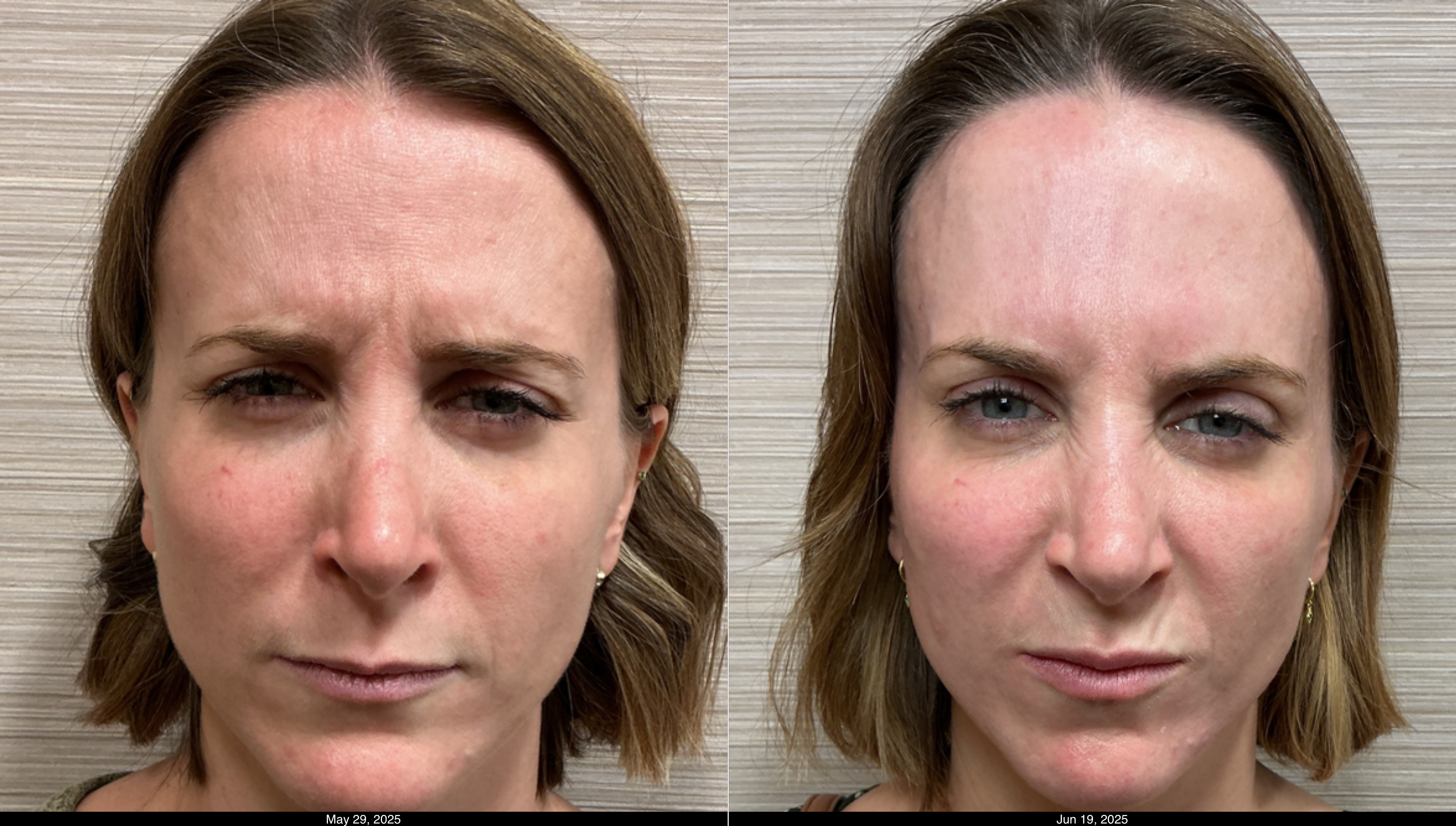 Btx fh, g, cf and filler lips (3)