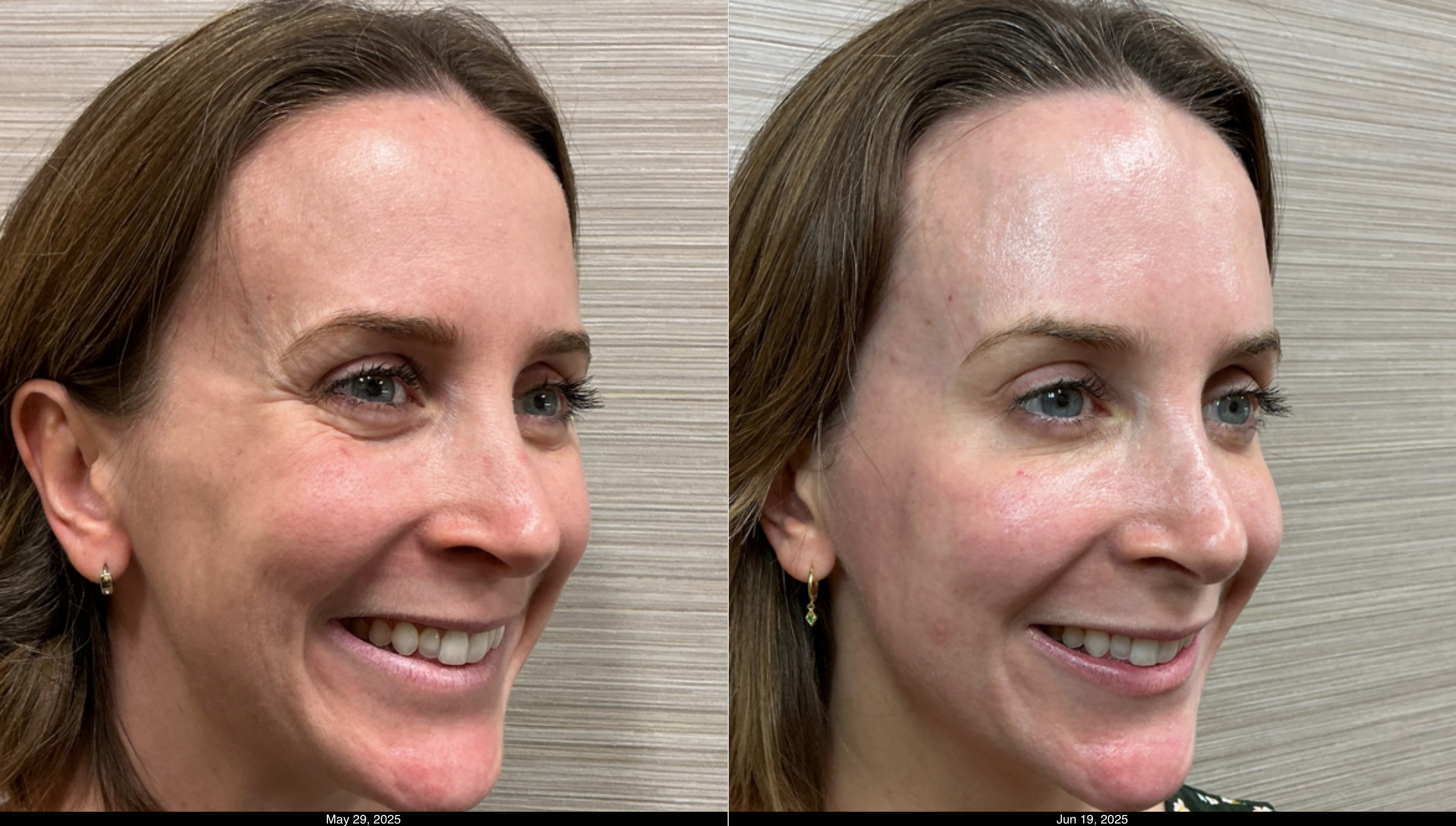 Btx fh, g, cf and filler lips (4)