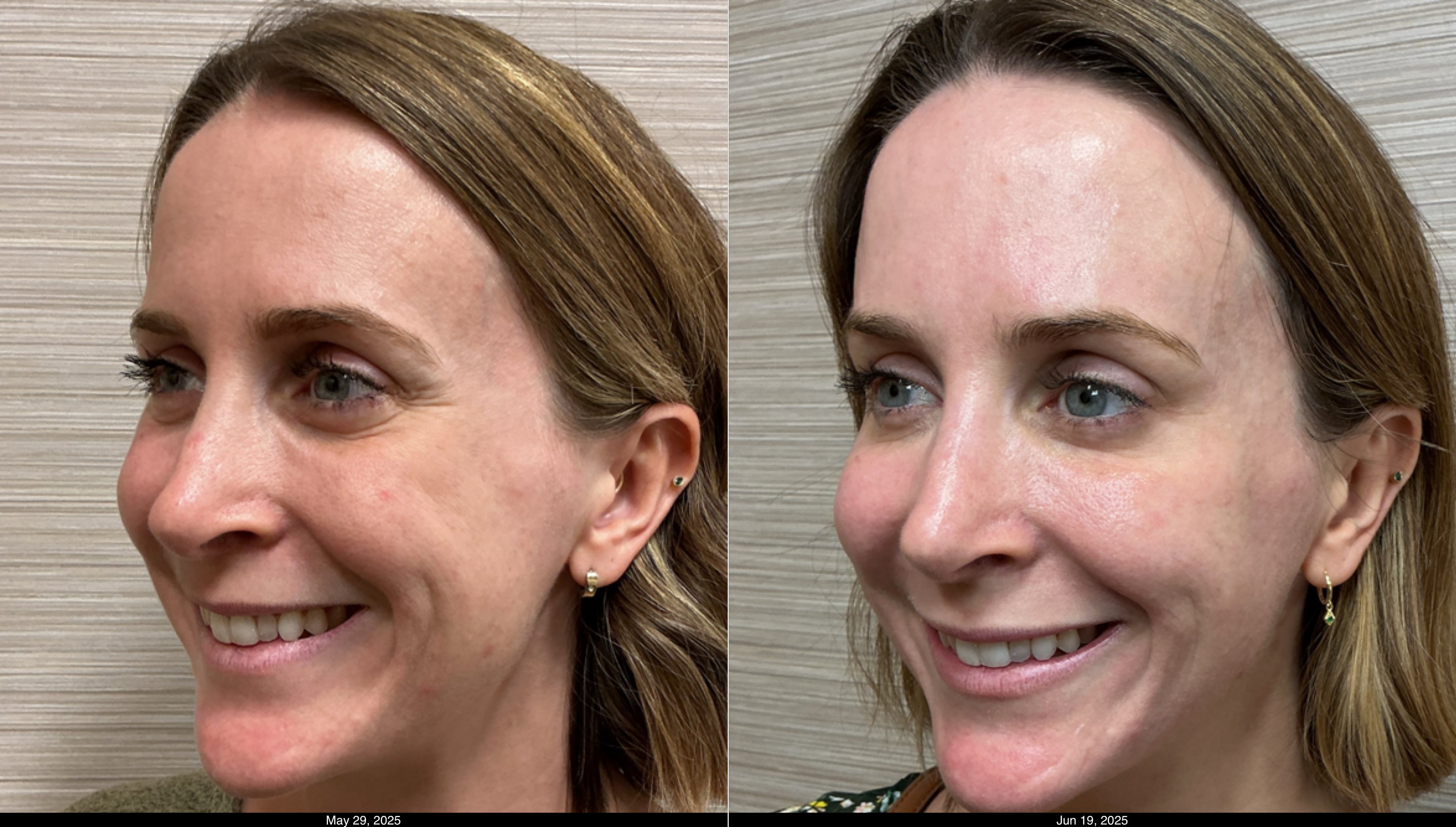 Btx fh, g, cf and filler lips (5)