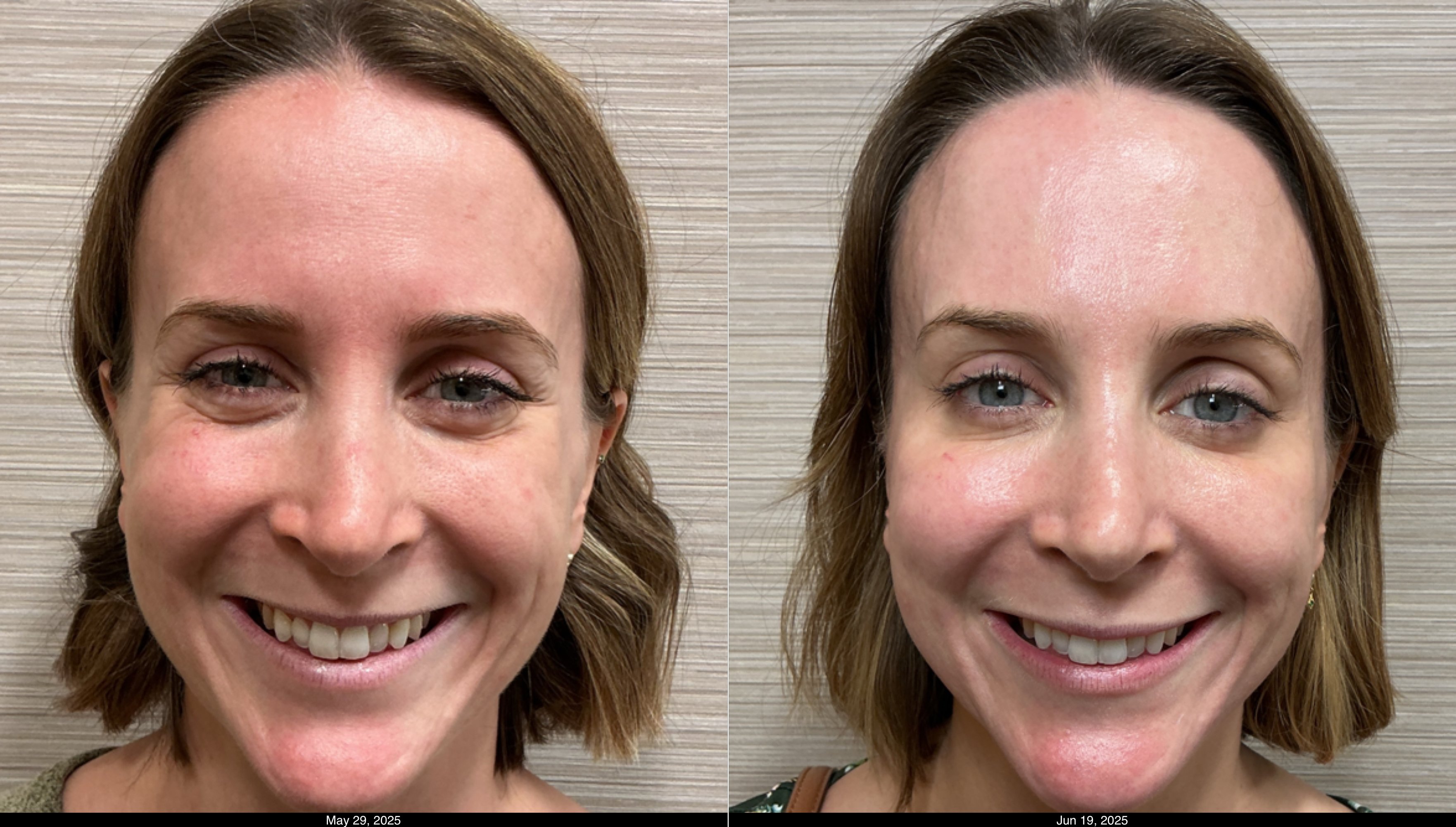 Btx fh, g, cf and filler lips (6)