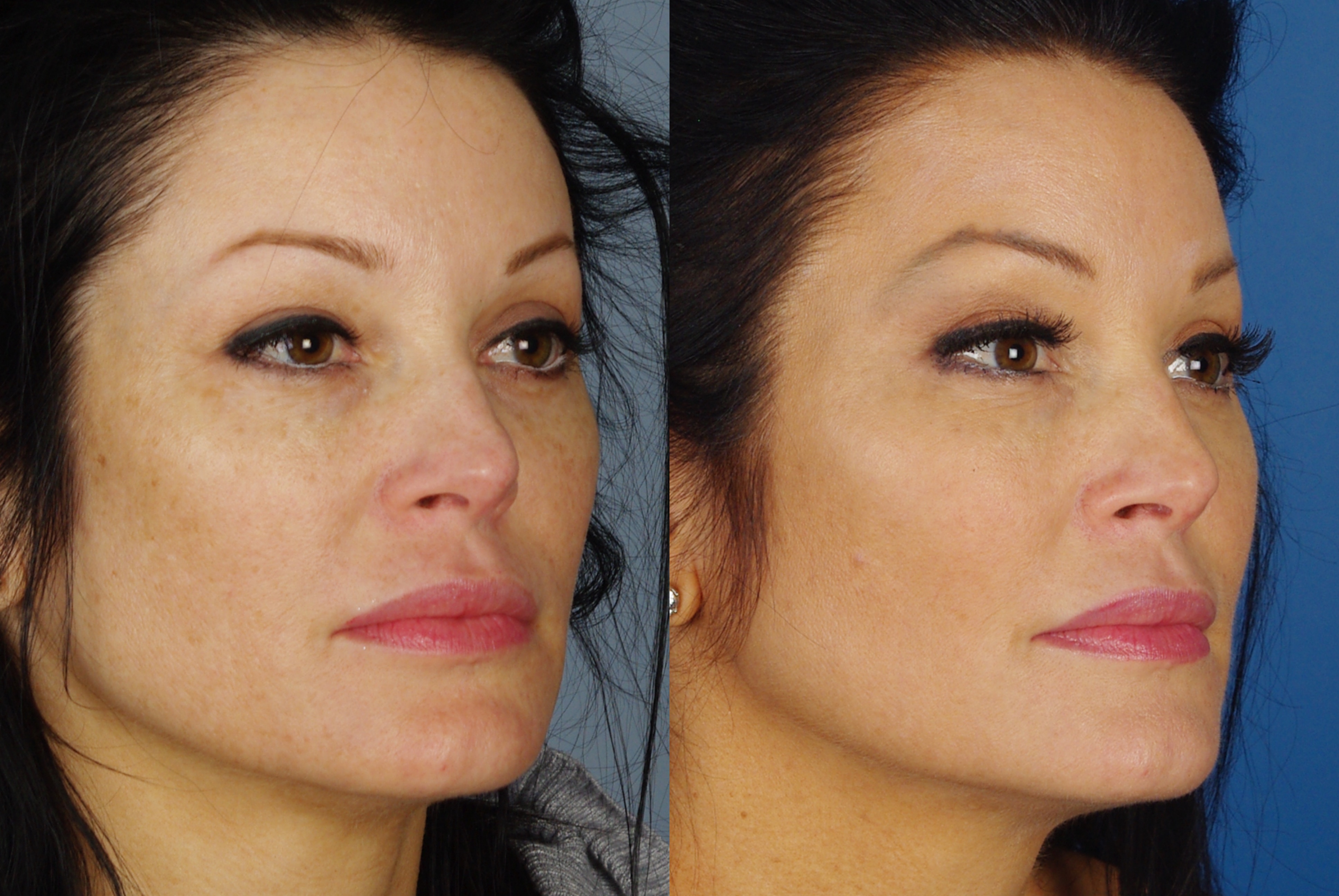 Light Pulse Treatment to Erase Age Spots and Sun Damage
