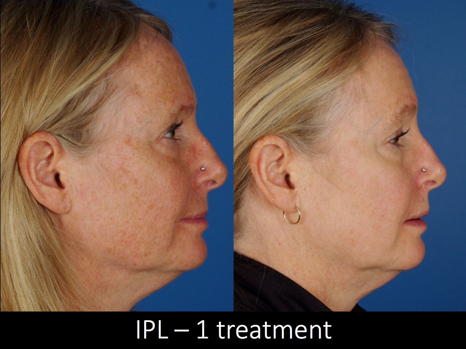 facial treatments-112-2 of 2