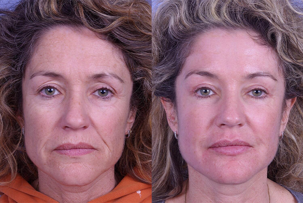 botox-filler-113-1 of 1