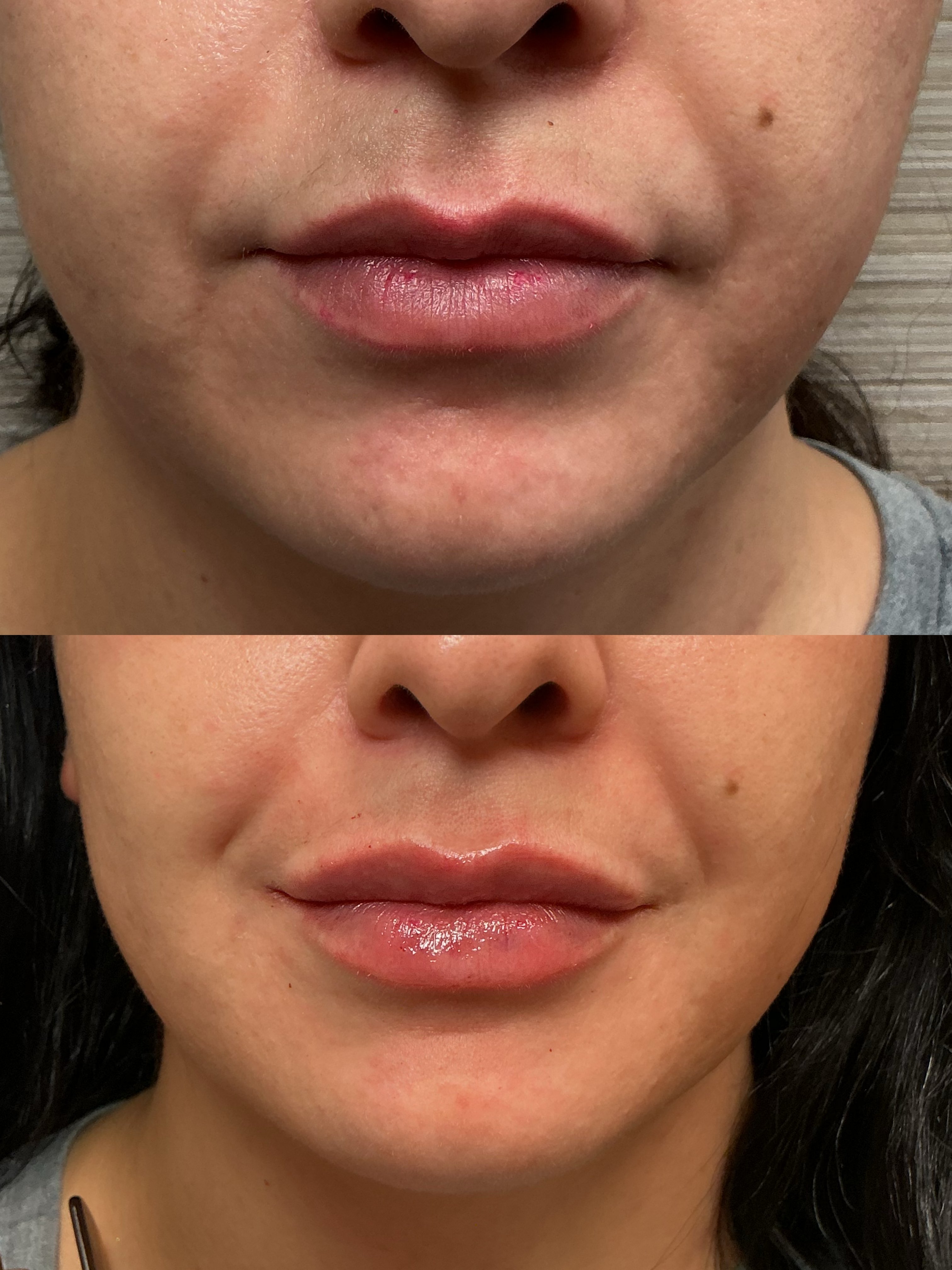 Juvederm Ultra 0.5cc