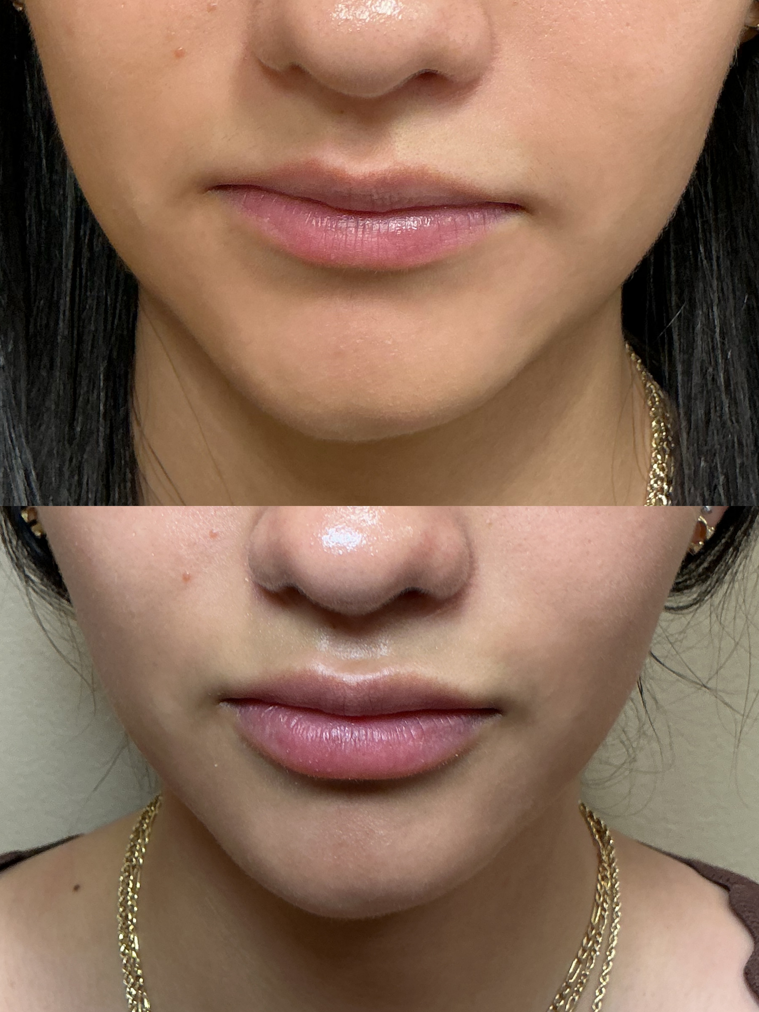Juvederm Ultra 1cc