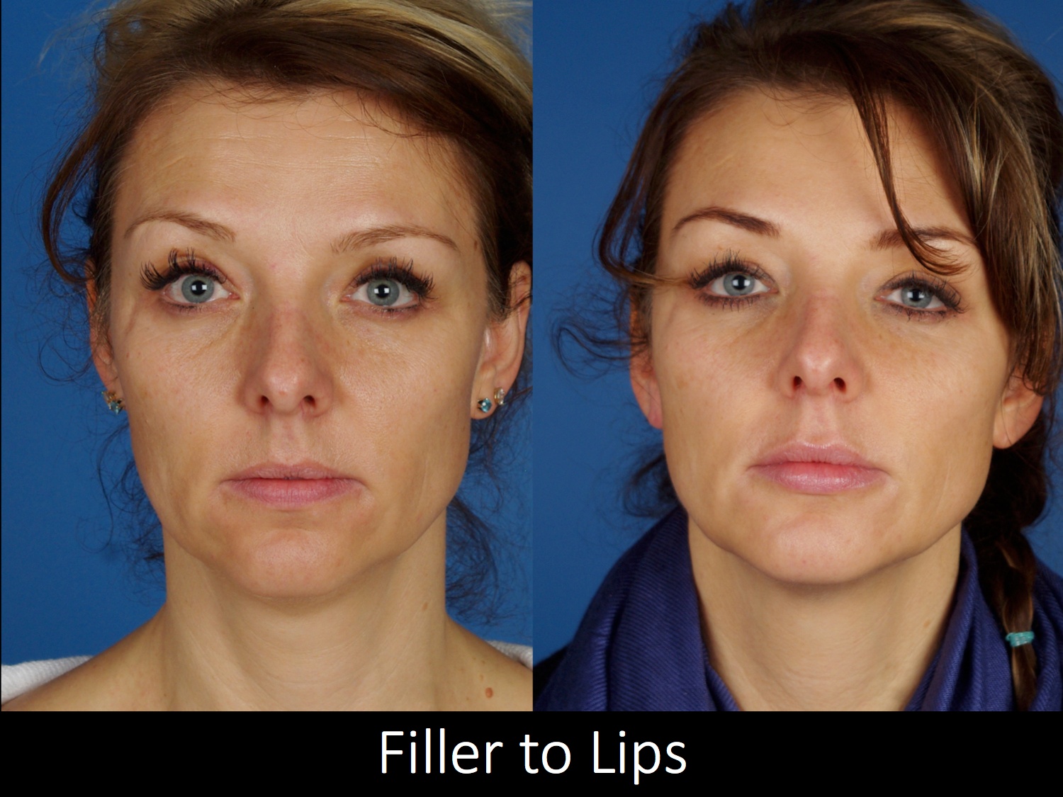 botox-filler-120-1 of 1