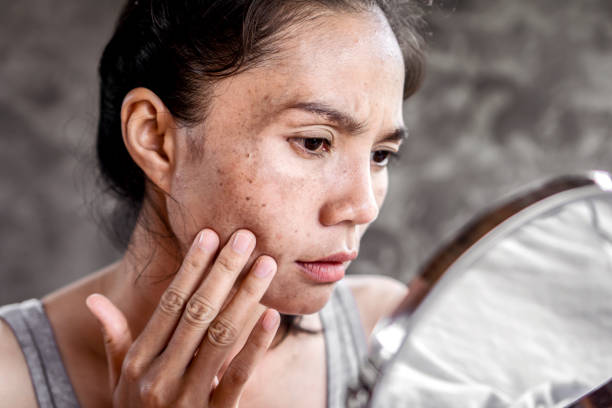 Denver Laser Brown Spot Removal Raval Facial Aesthetics