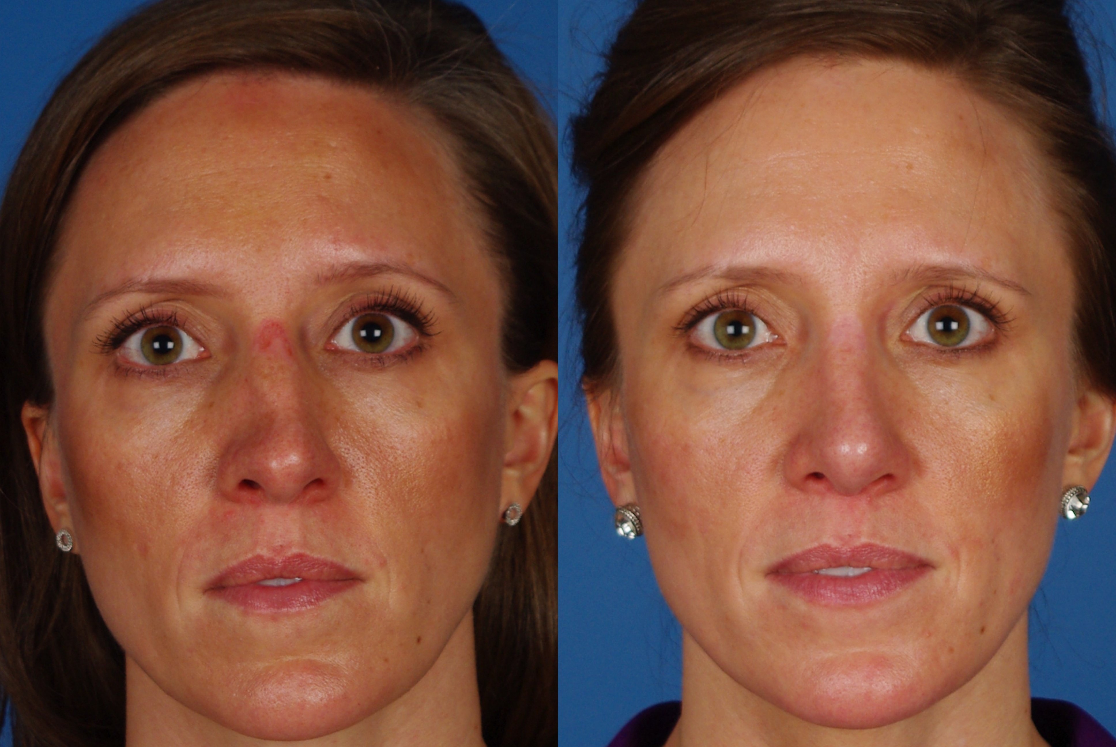 Rhinoplasty Recovery