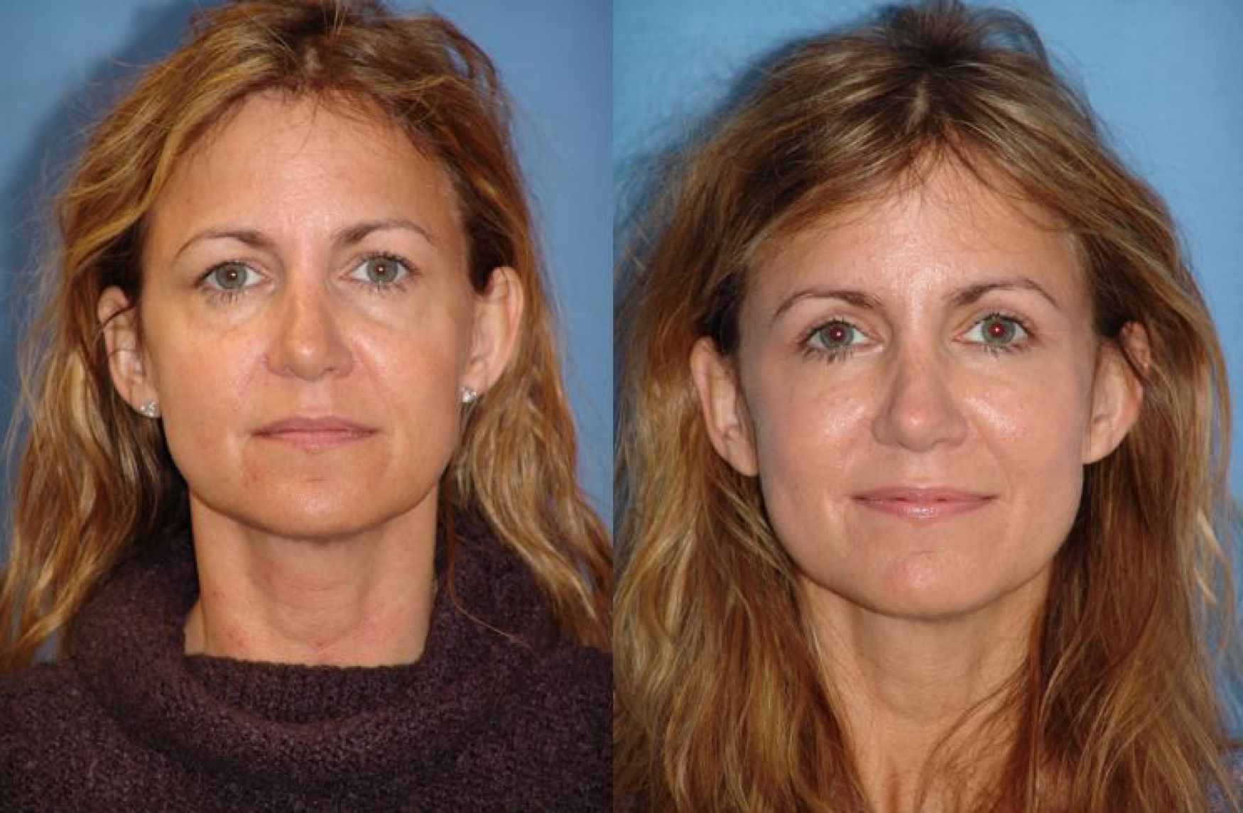 blepharoplasty-103-1 of 1