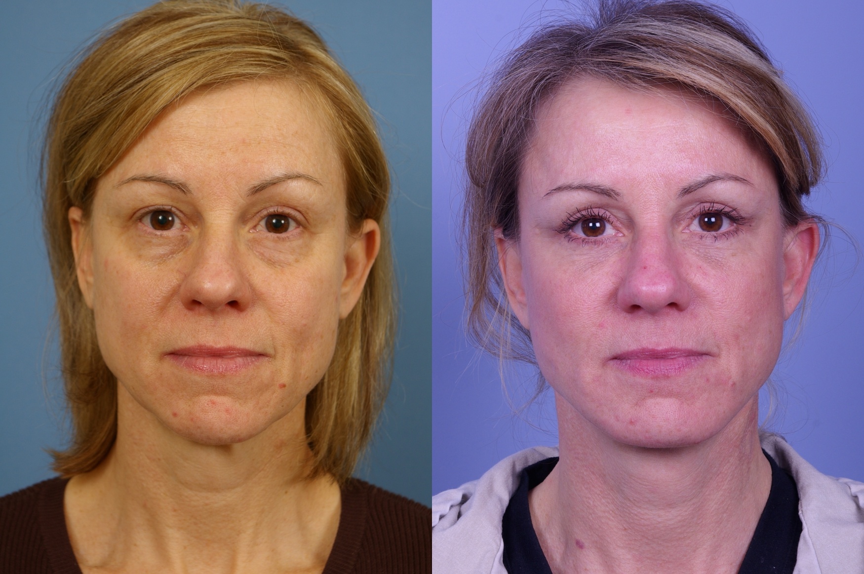 blepharoplasty-108-1 of 1