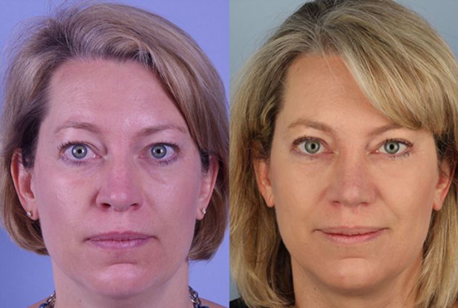 blepharoplasty-101-1 of 1