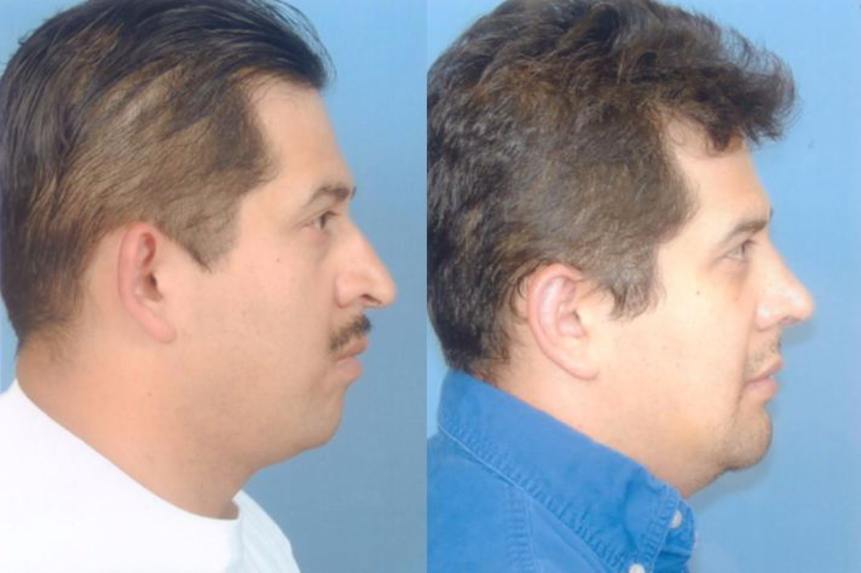 chin augmentation-101-1 of 2