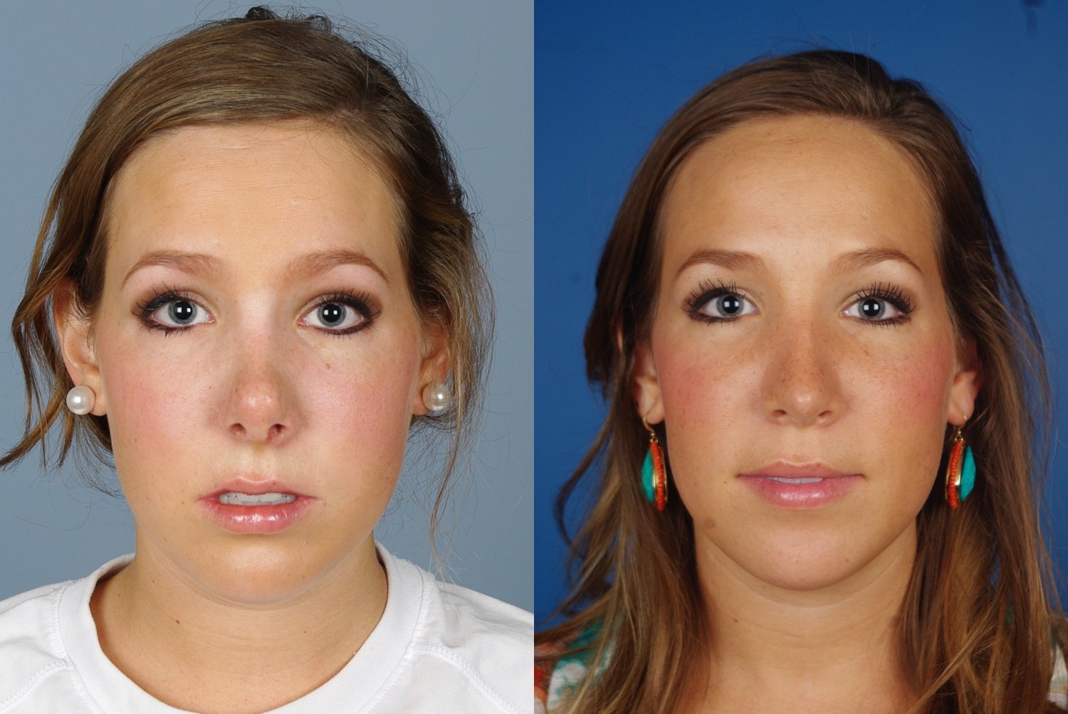 Rhinoplasty Before & After Photos - Yarish Plastic Surgery
