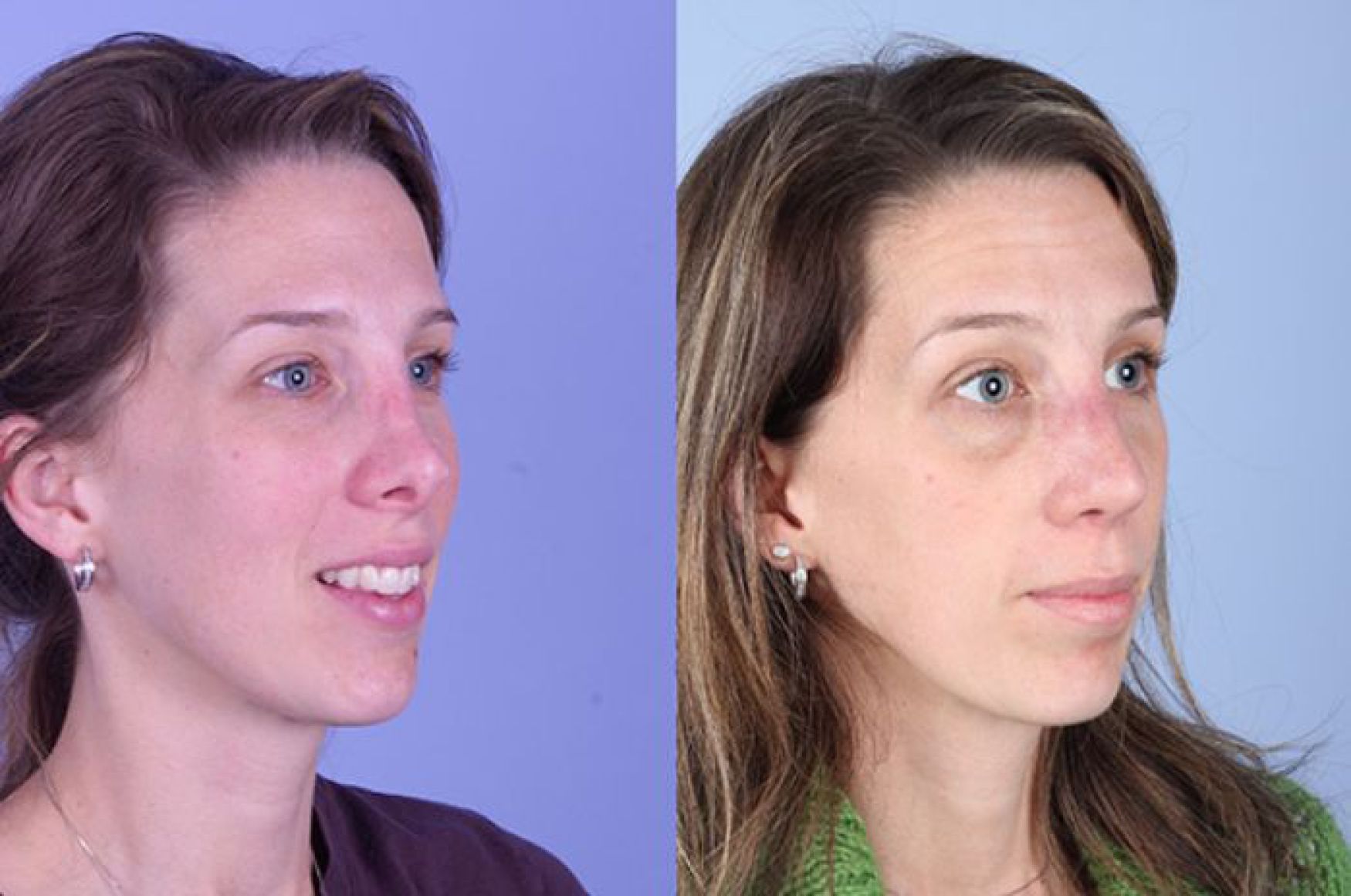 Simple When can you workout after rhinoplasty for Women