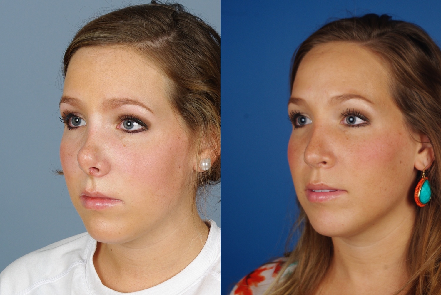 Denver Revision Rhinoplasty Before and Afters Raval