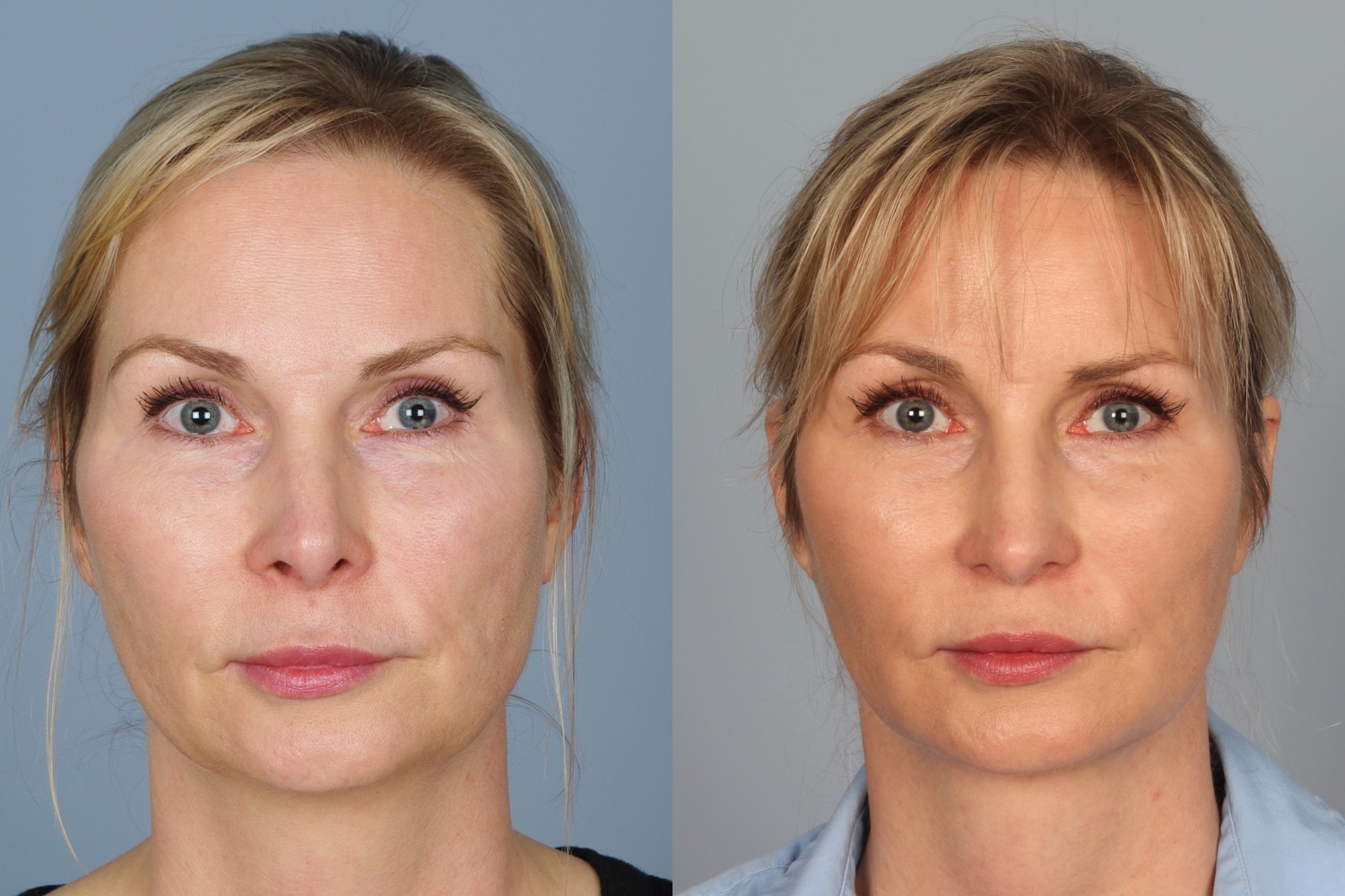 Denver Revision Rhinoplasty Before and Afters Raval