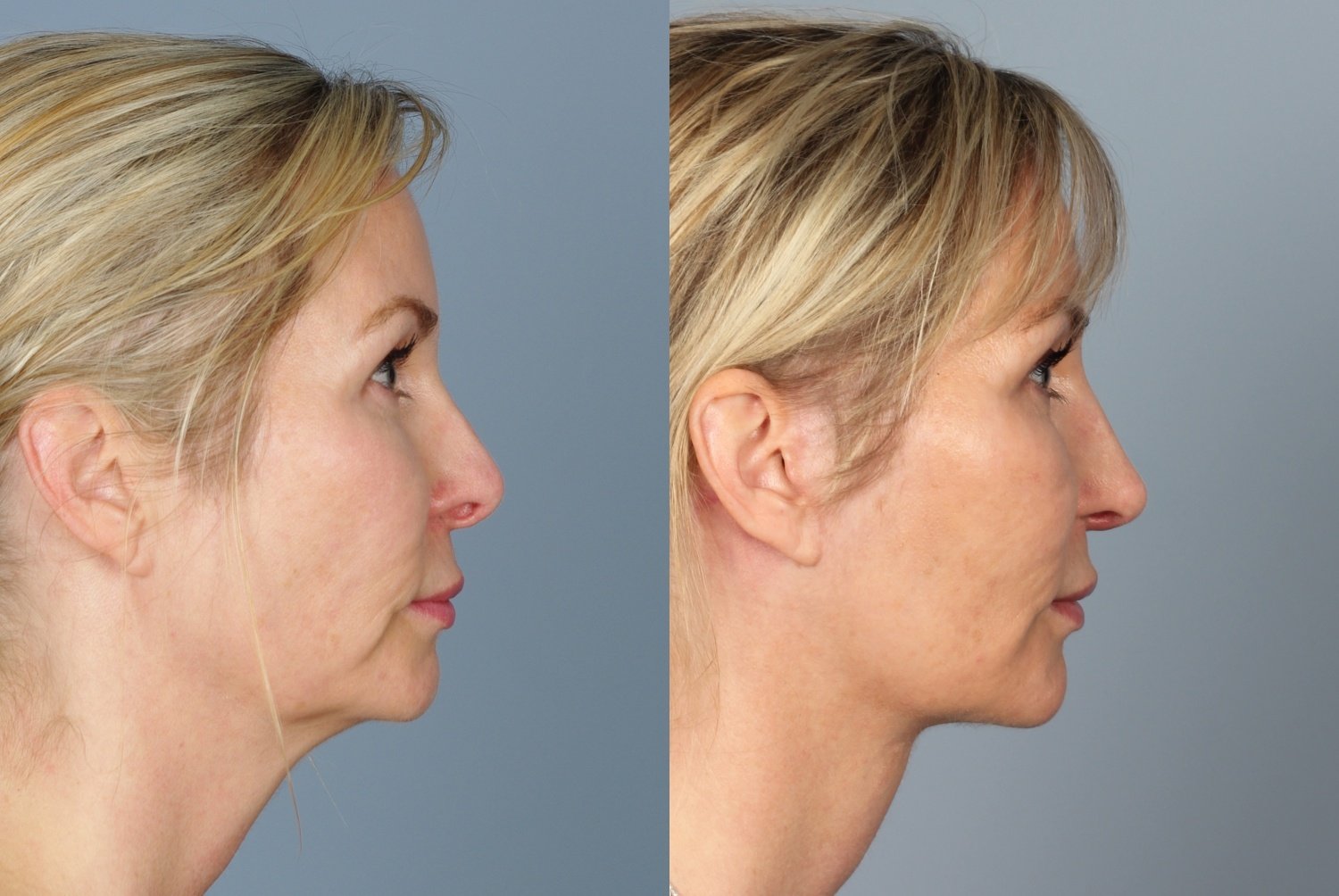  When can you workout after rhinoplasty for Fat Body