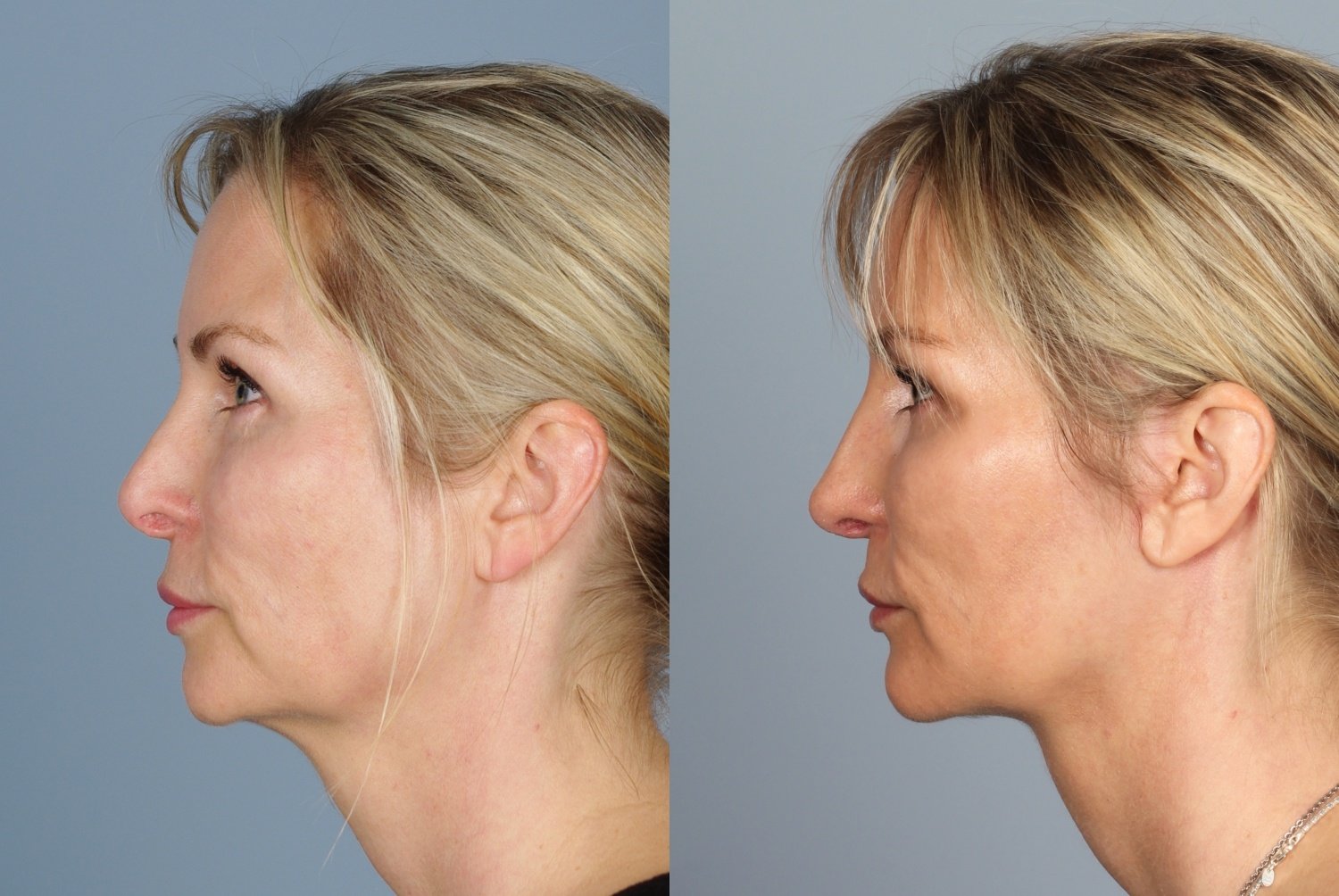 5 Day When Can You Workout After Rhinoplasty for Beginner