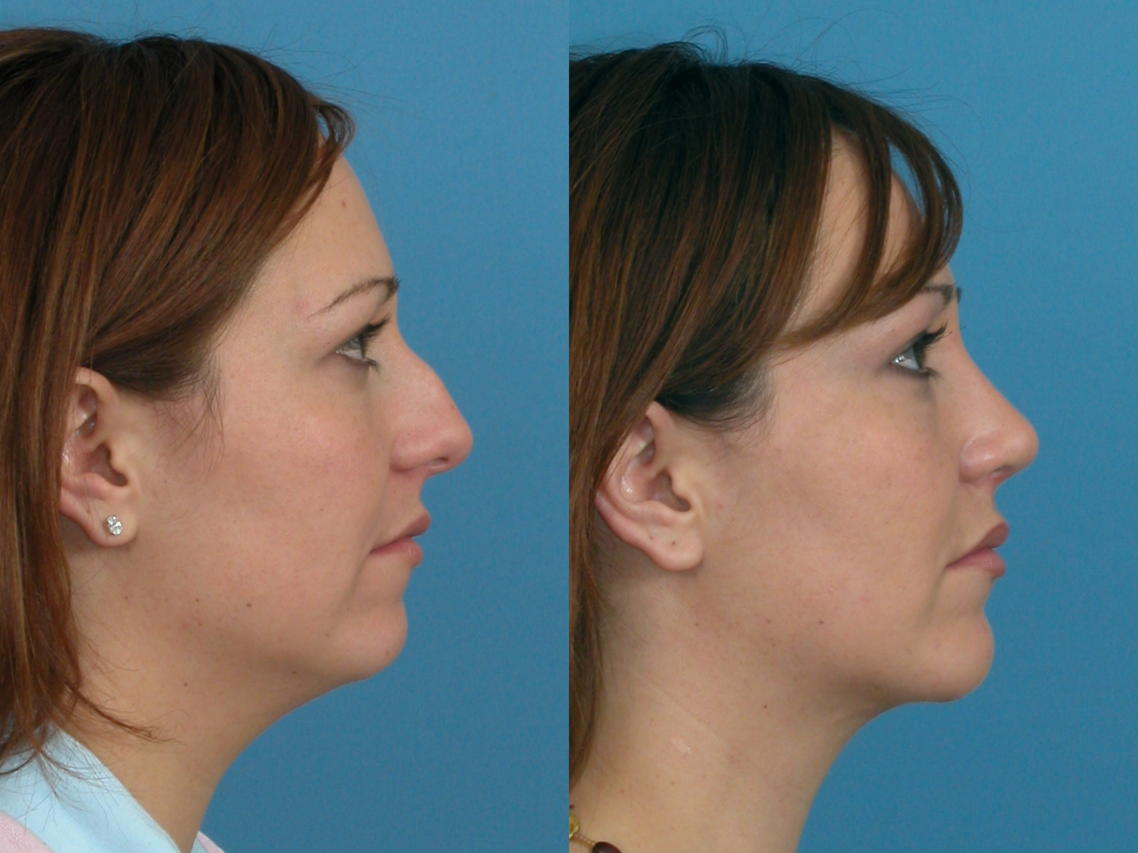 chin augmentation-103-1 of 1*