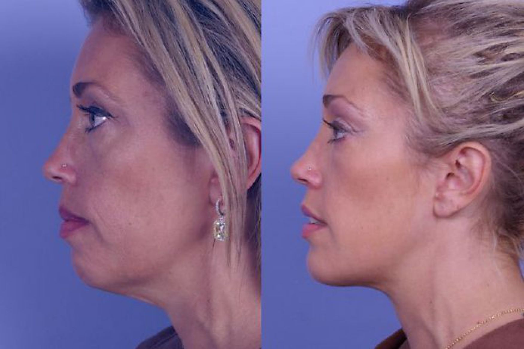 chin augmentation-104-1 of 1