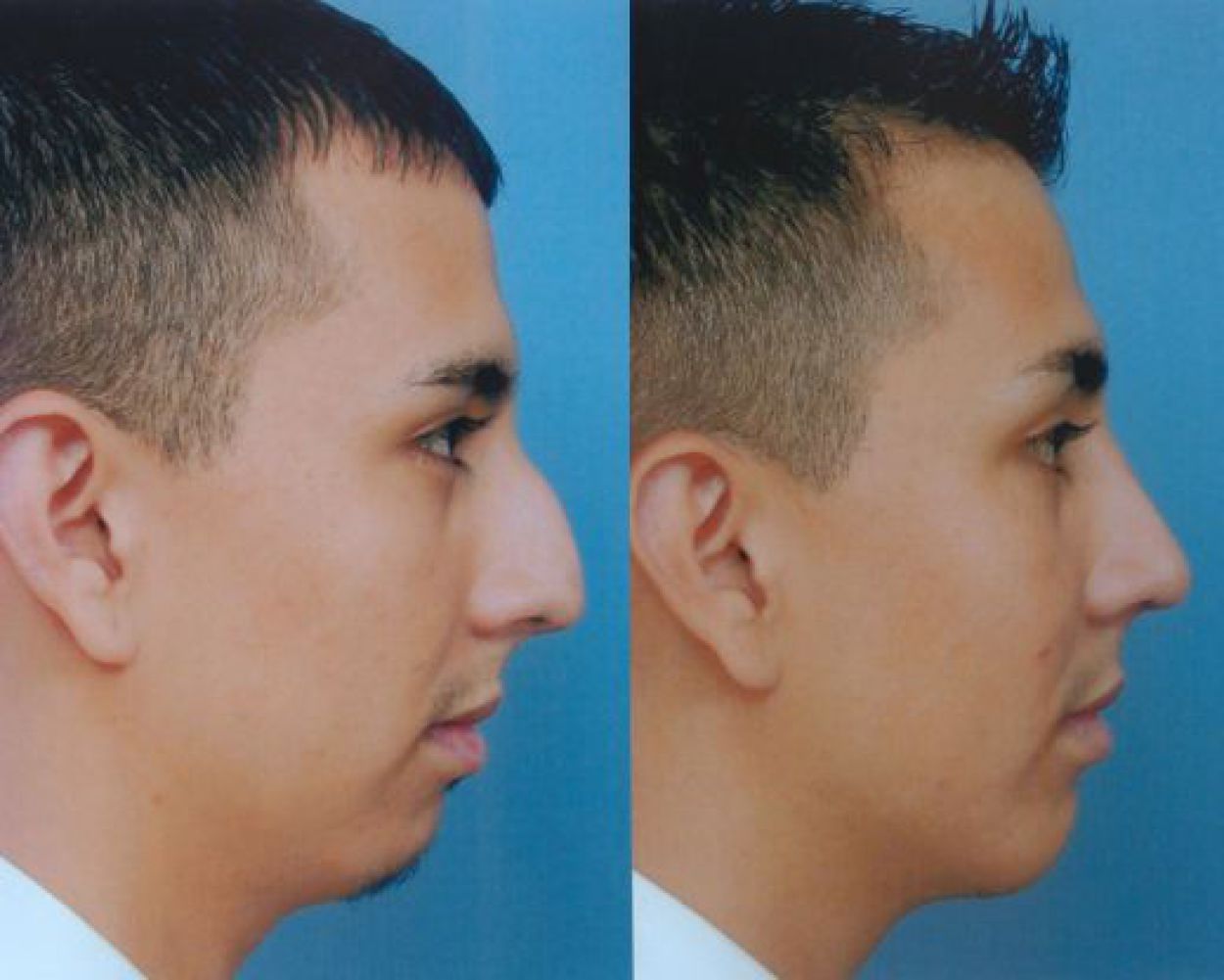 chin augmentation-102-1 of 1