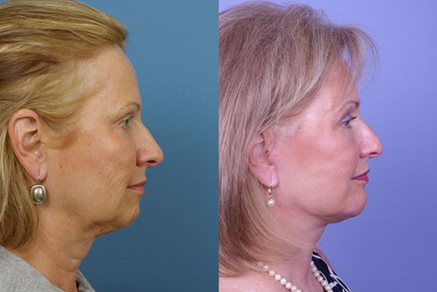 chin augmentation-106-1 of 1