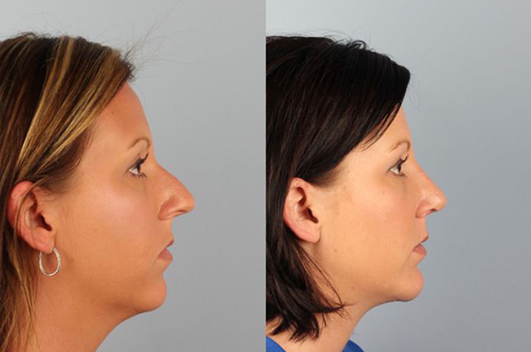 chin augmentation-107-1 of 1