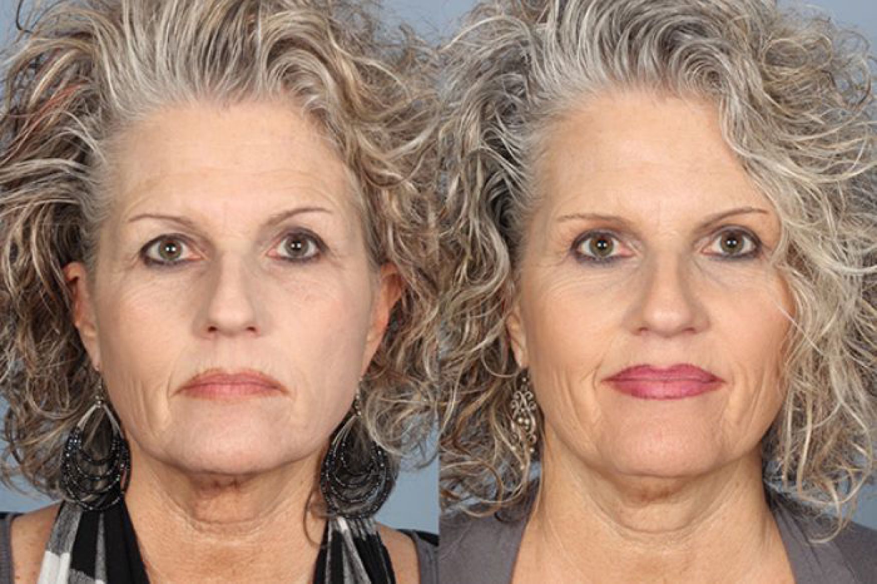 blepharoplasty-102-1 of 1