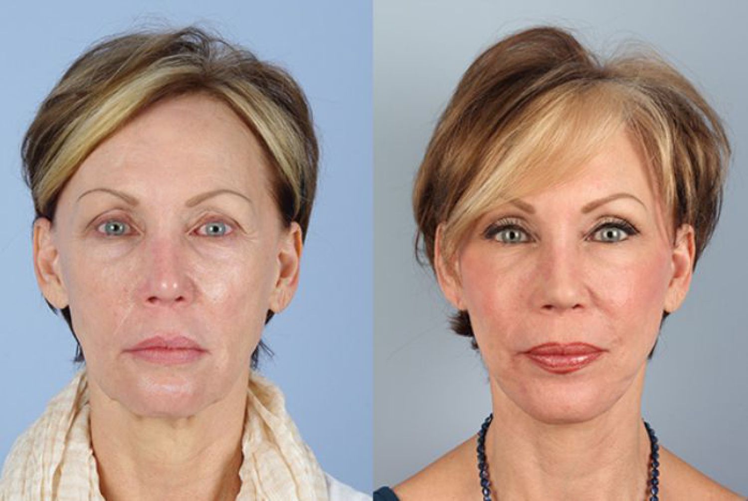 botox-filler-100-1 of 1