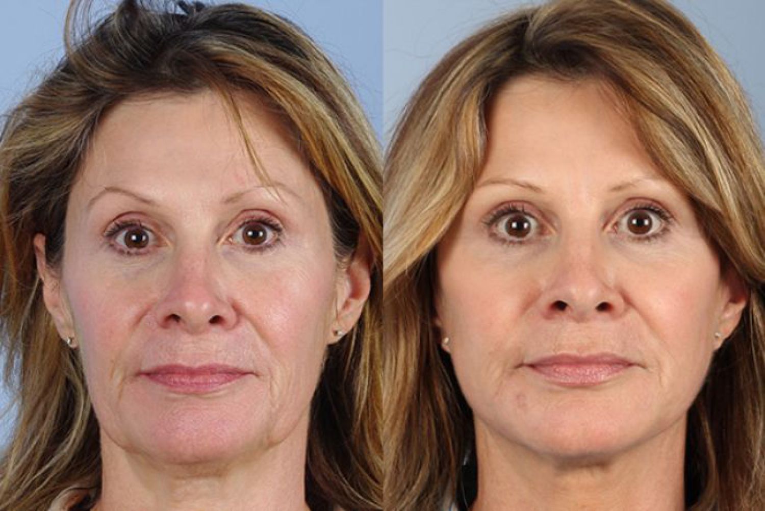 botox-filler-101-1 of 1