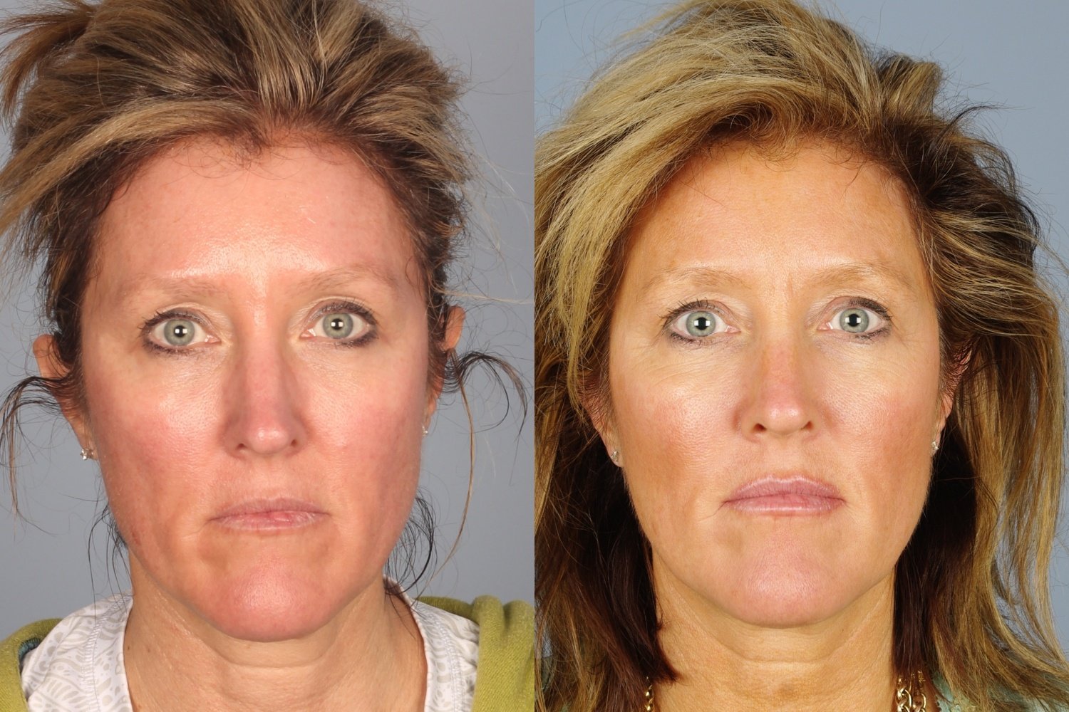 botox-filler-109-1 of 1