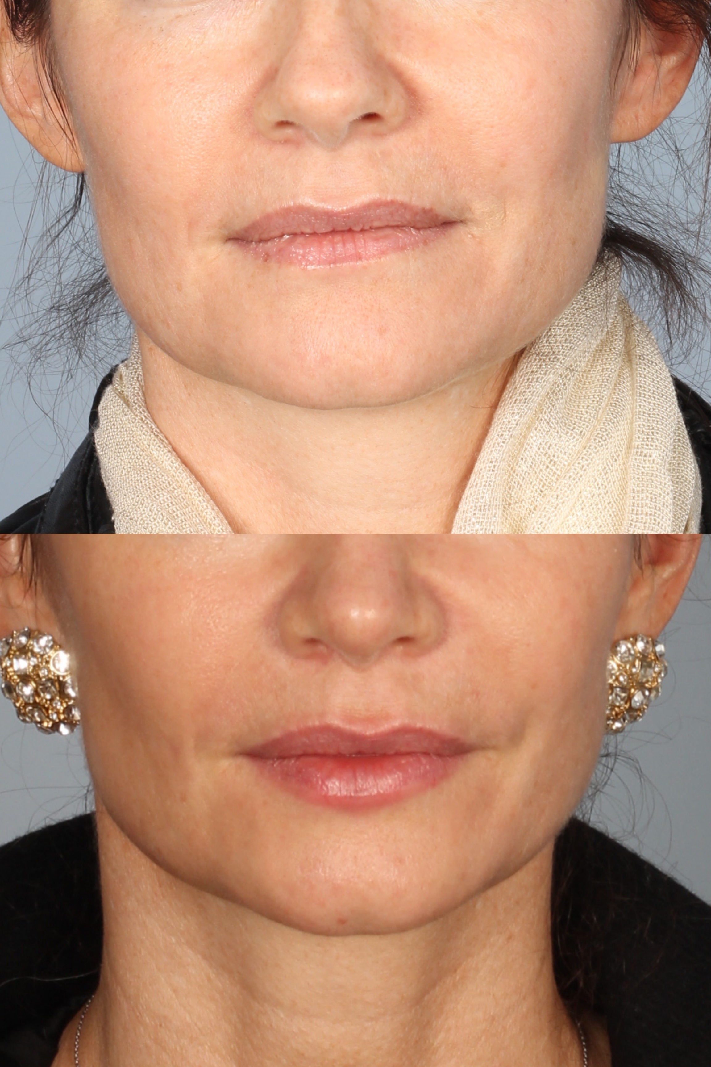 Denver Botox and Fillers Before and Afters Raval Facial Aesthetics