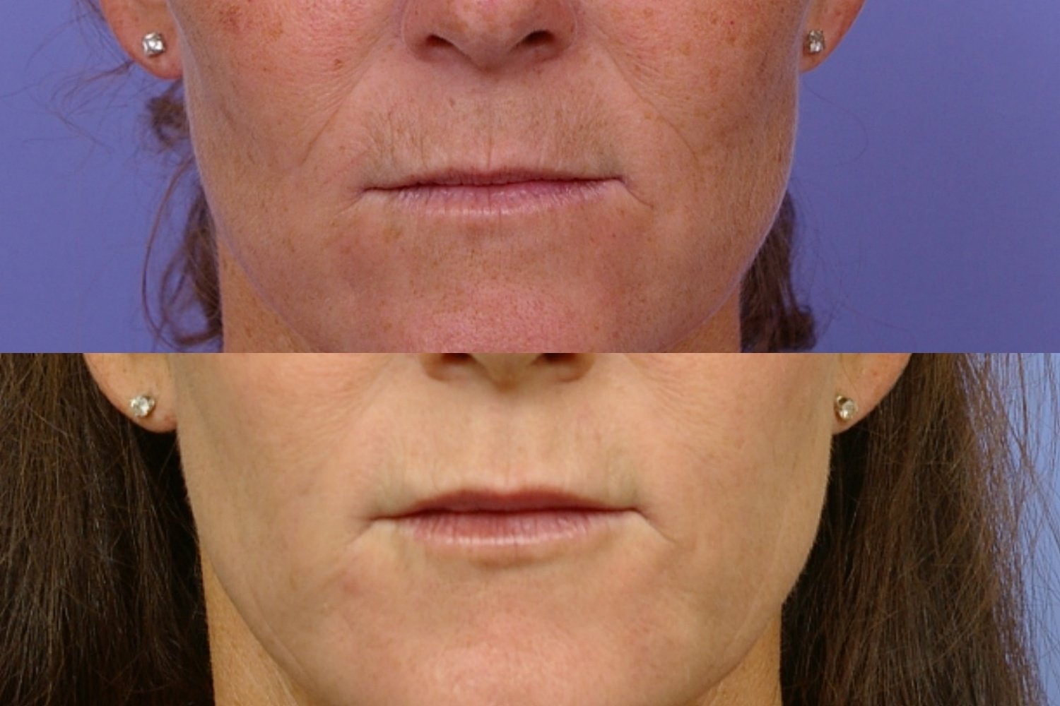 botox-filler-106-1 of 1