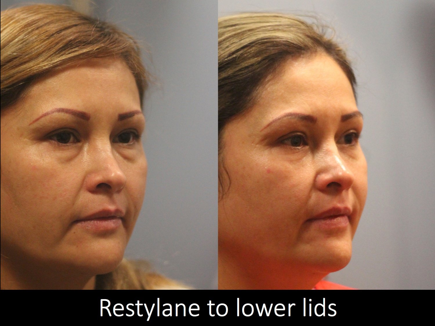 botox-filler-119-2 of 3