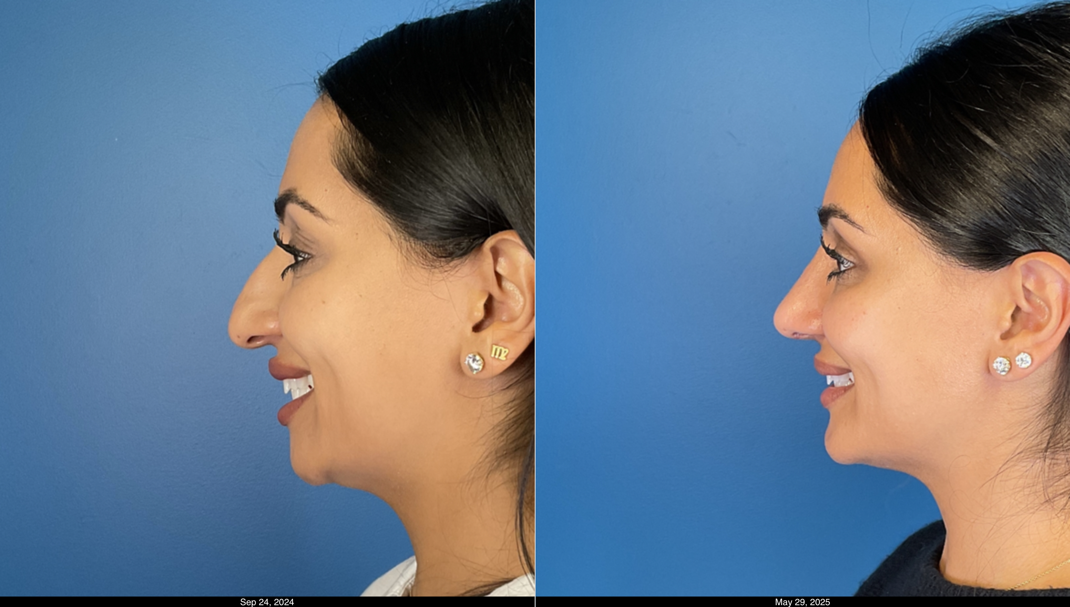 Rhino and chin aug before and after