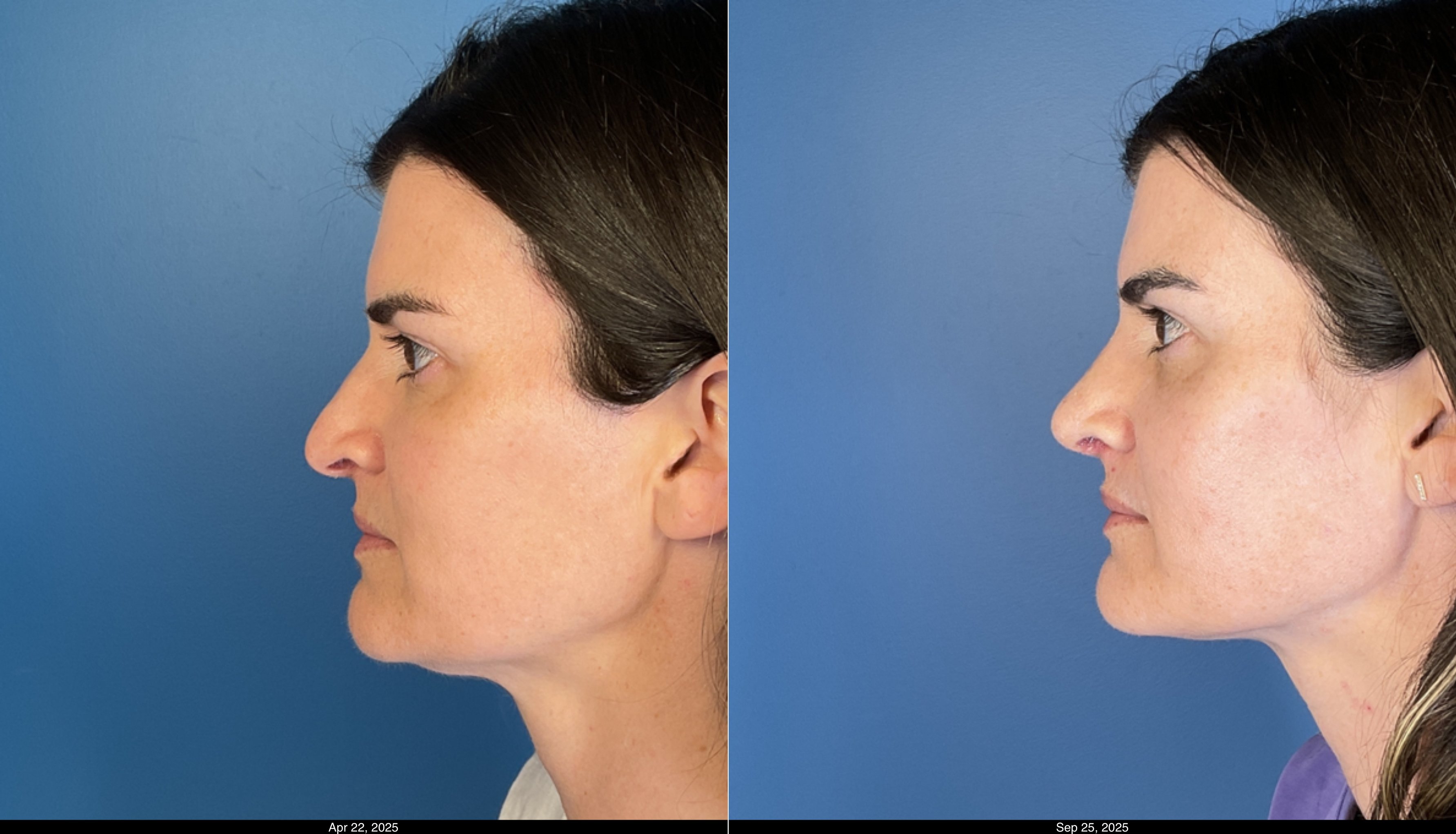 Rhinoplasty 1 month post op  (1)