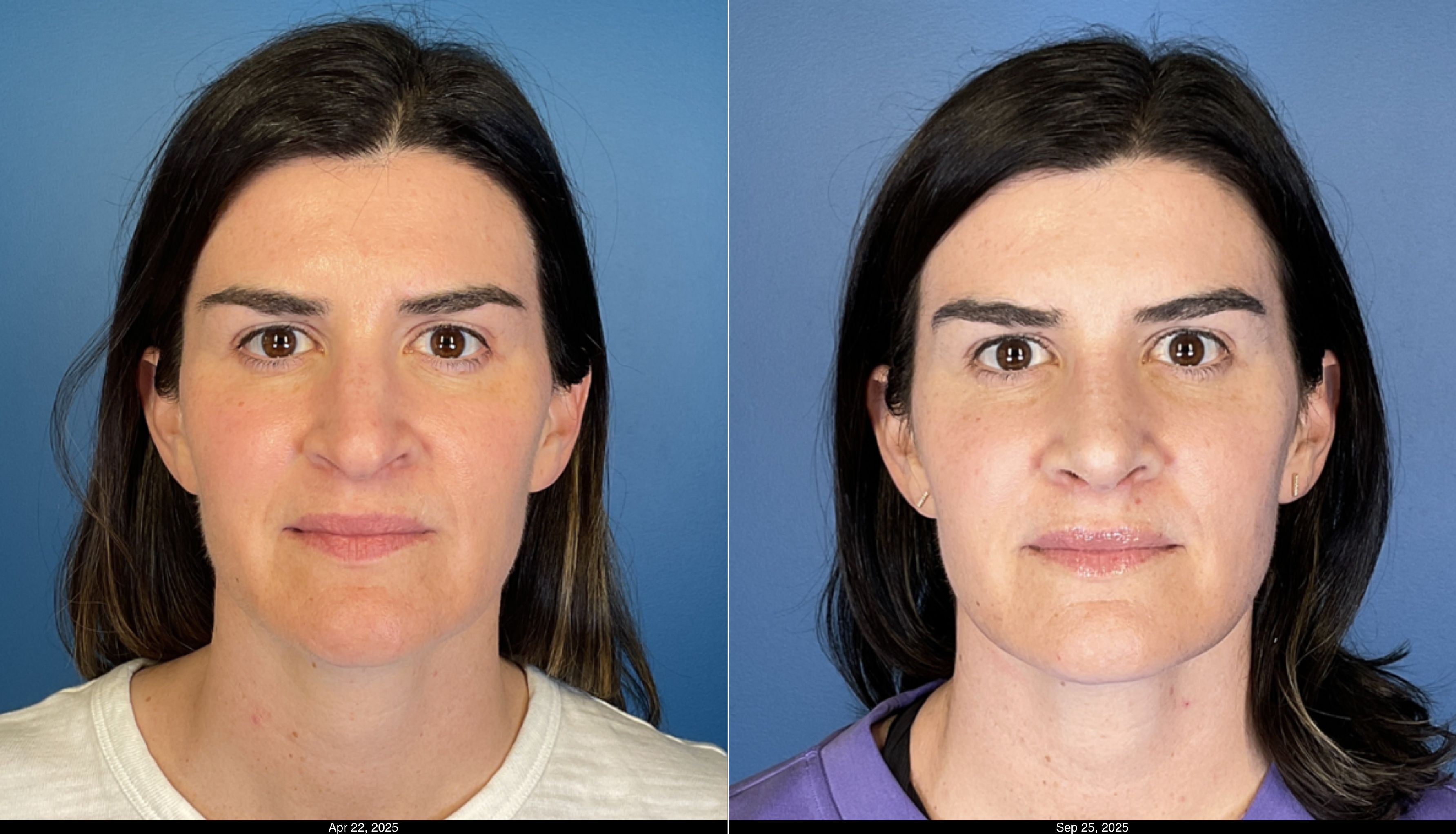 Rhinoplasty 1 month post op  (3)