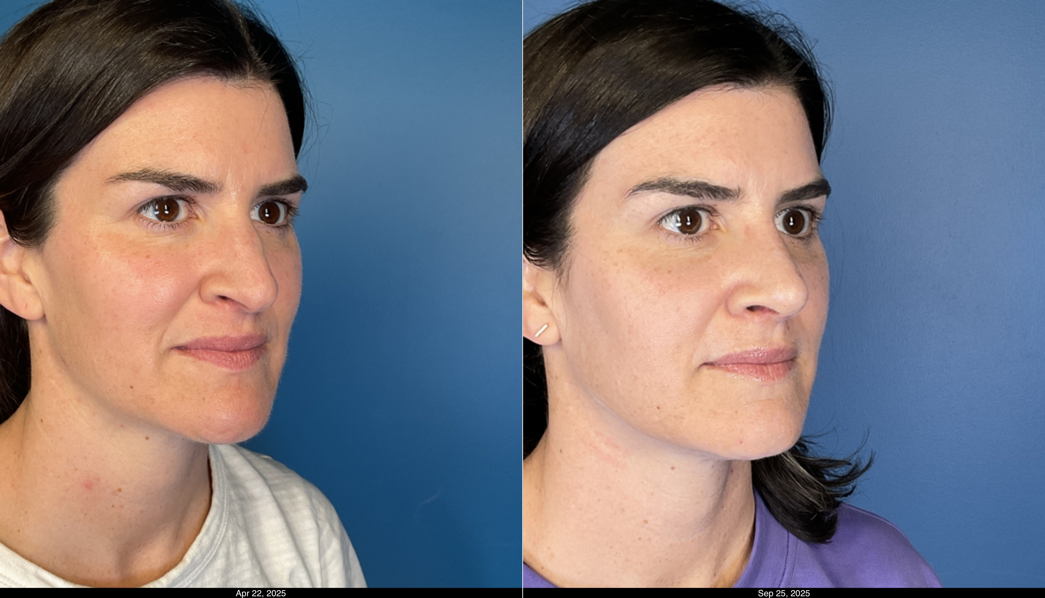 Rhinoplasty 1 month post op  (4)