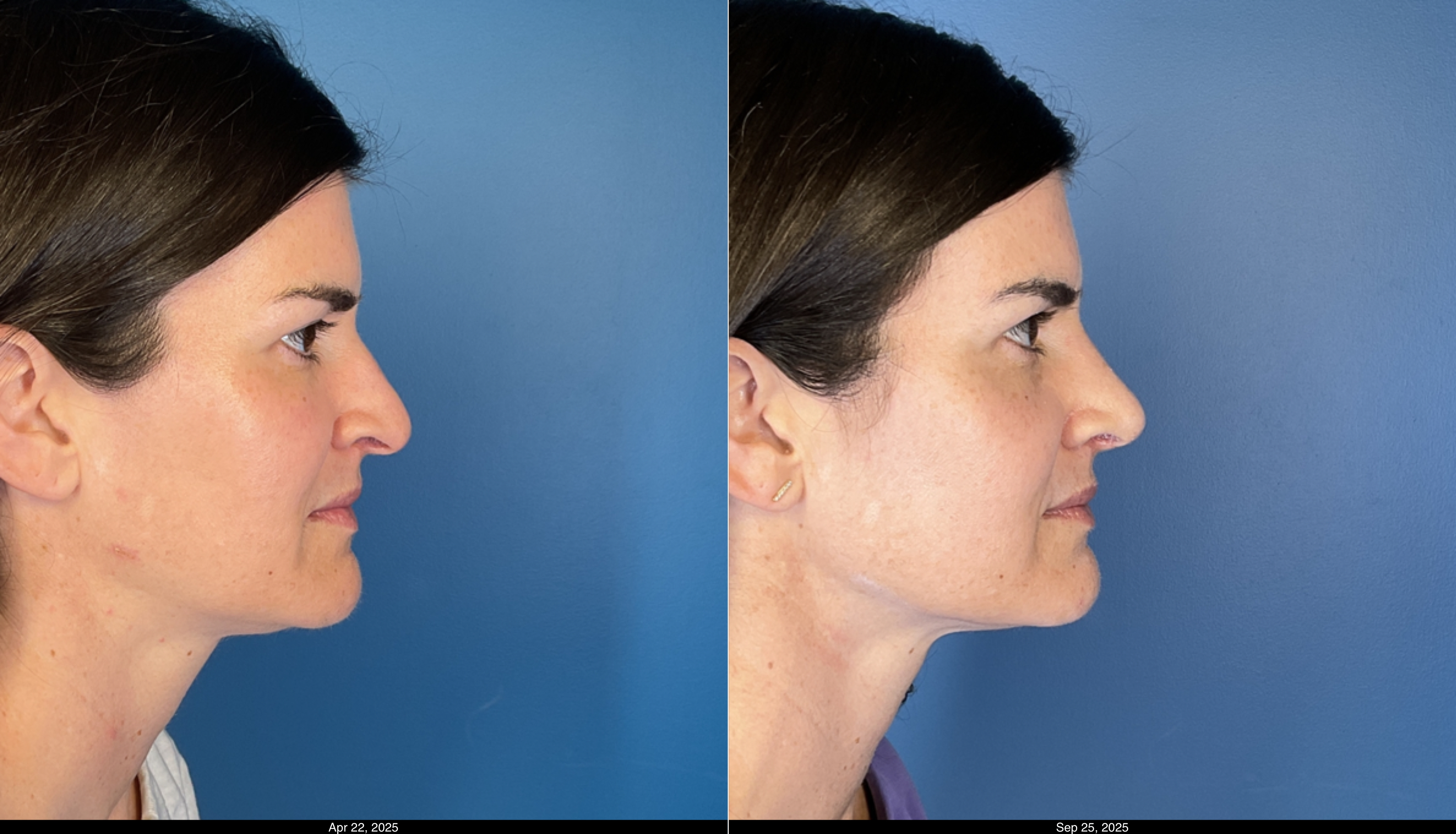 Rhinoplasty 1 month post op  (5)