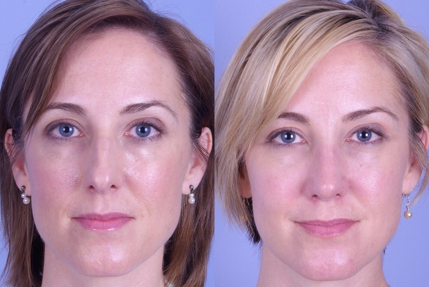 Rhinoplasty Results