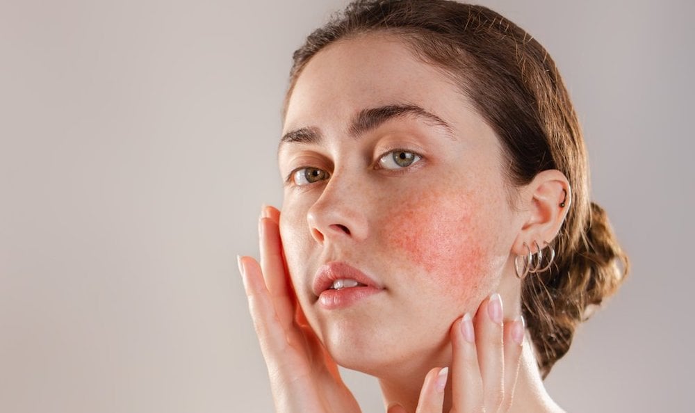 Laser Skin Treatments for Rosacea