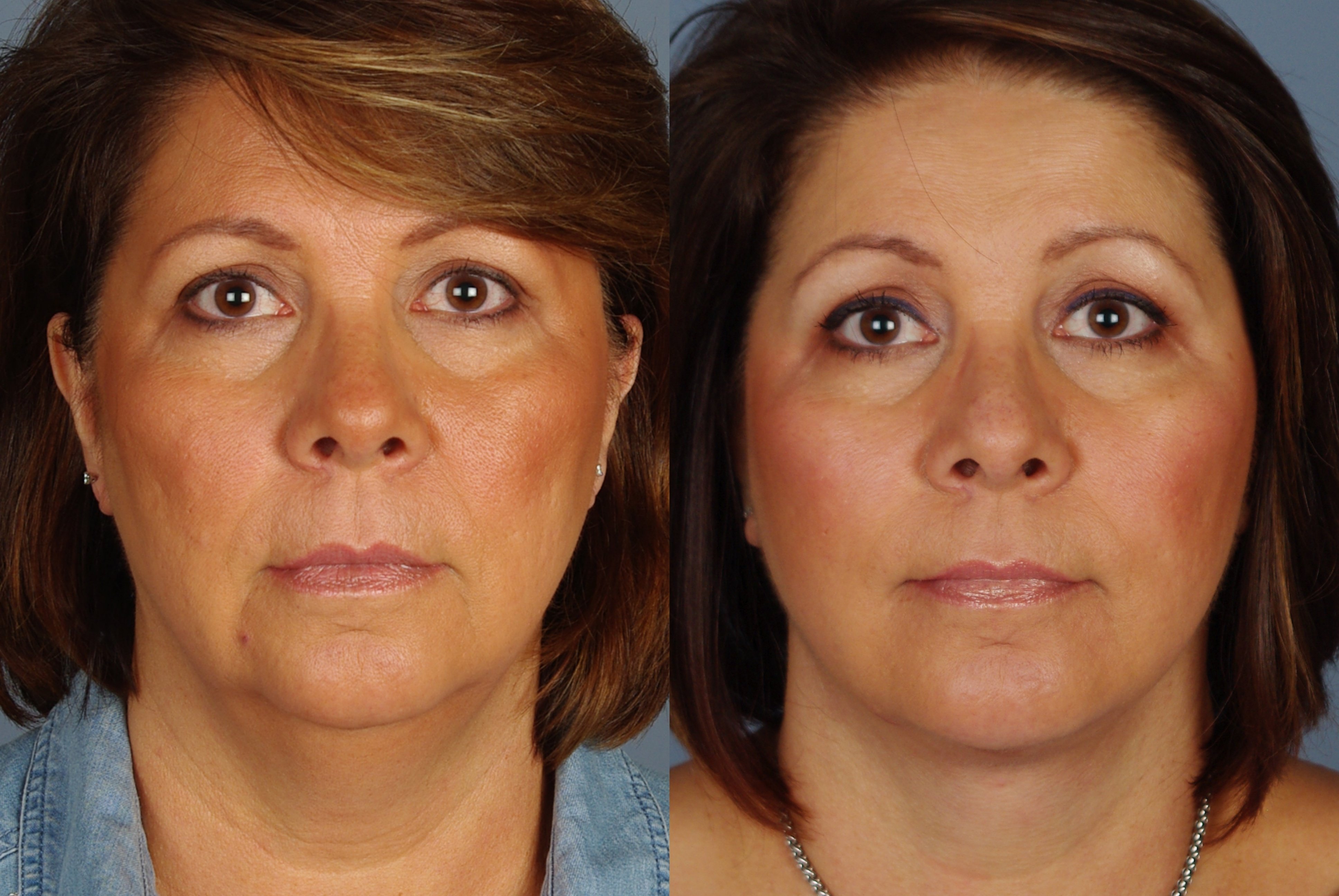 What is a Facelift?