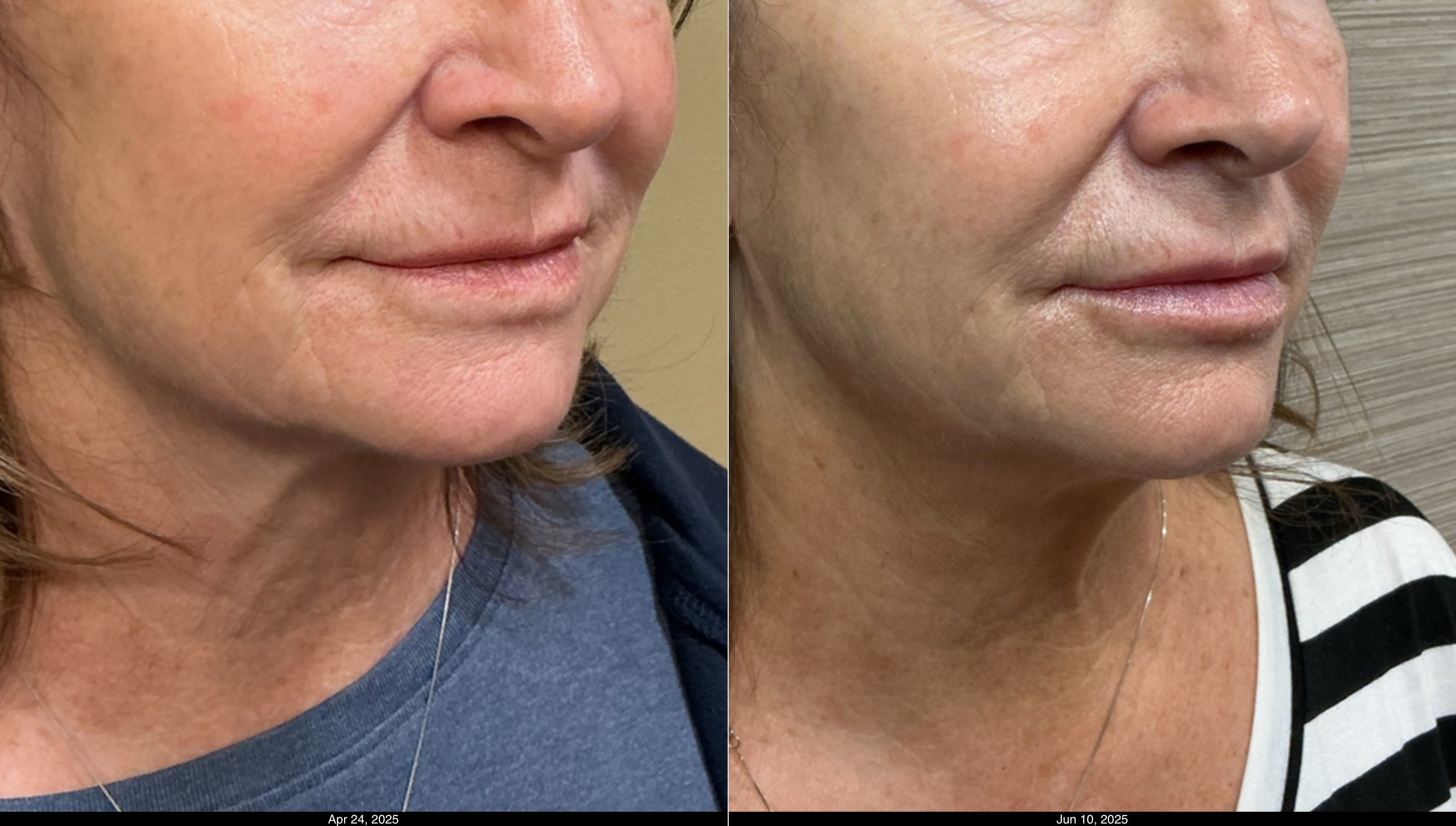 SkinVive and Restylane Kysse (2)