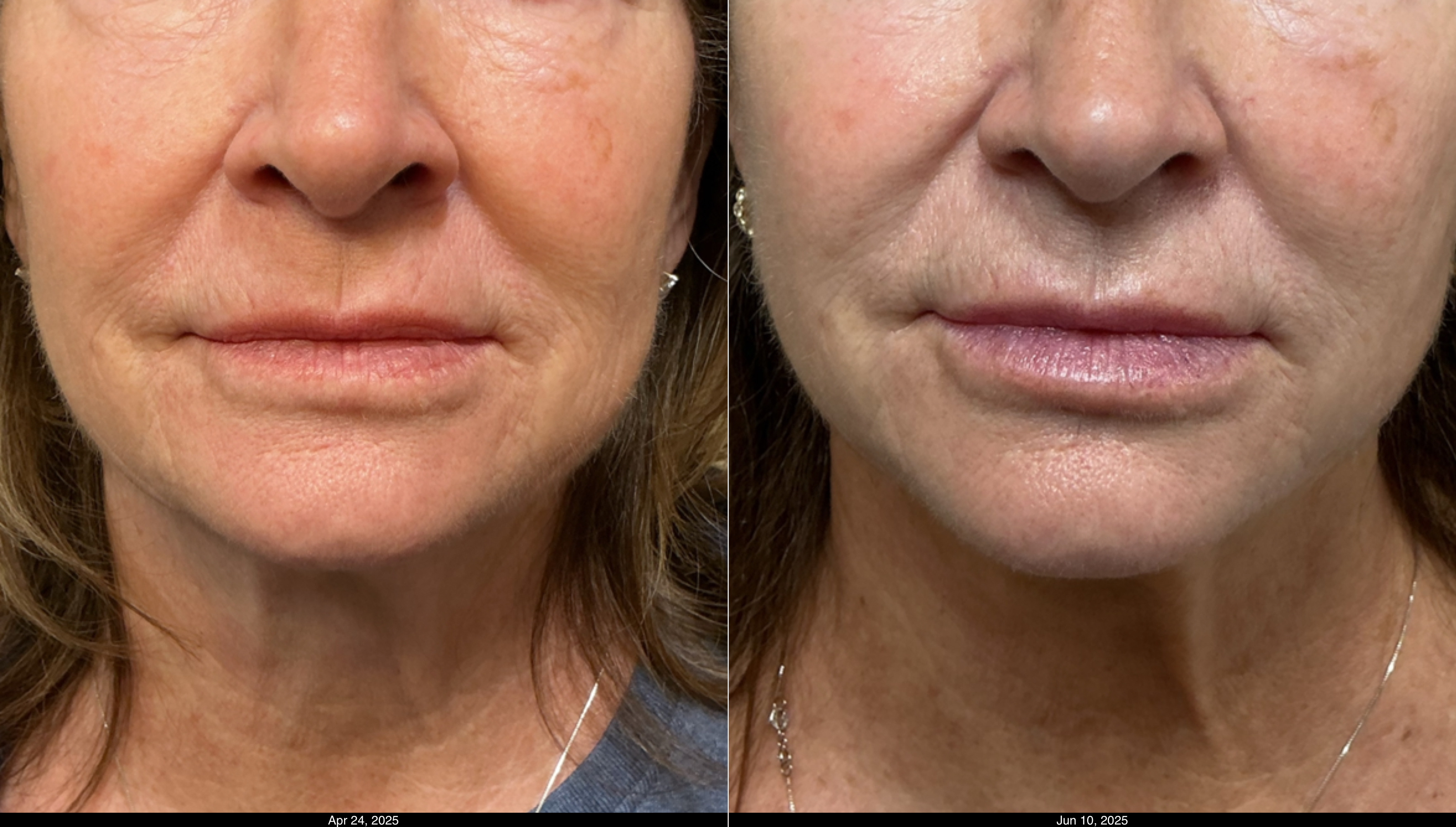 SkinVive and Restylane Kysse (3)